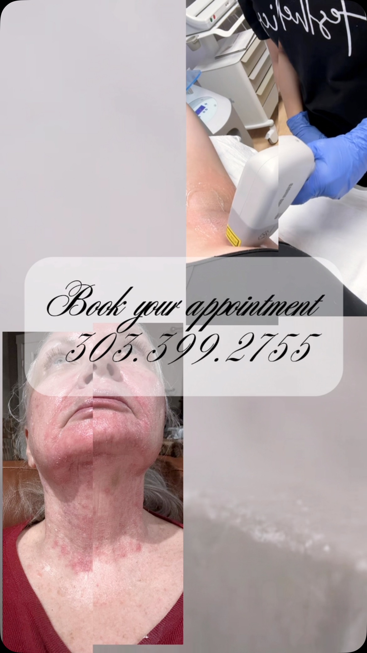 🌟 Transform Your Look at. 🌟City Skin MD! 🌟
✨ Skin Resurfacing for the Neck: Smooth and rejuvenate for a youthful glow.
✨ Laser Hair Removal: Say goodbye to unwanted hair for good!
✨ Filler for Nasolabial Folds: Restore volume and soften lines.
📍 Location: City Skin MD – Your beauty sanctuary in 495 Uinta Way Ste 130 Denver!
📞 Call 303.399.2855
💬 Hablamos Español – ¡Llámanos hoy!
www.cityskinmds.com
💻 Book now and let’s create your perfect look!
#WeAreCitySkin #BeautyMeetsInnovation #denverskincare