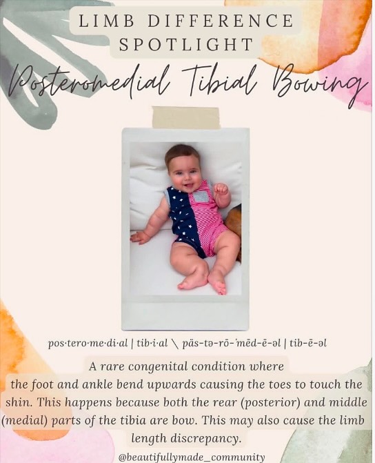 ✨Limb Difference Spotlight✨
Posteromedial Tibial Bowing
\ pos· tero· me· di· al | \ päs-tə-rō-ˈmēd-ē əl :located on or near the dorsal midline of the body or a body part.
tib·i·al | \ ˈtib-ē-əl : of, relating to, or located near a tibia.
“Posteromedial Tibial Bowing is a congenital condition, impacting around 1 in 40,000, in which there is both posterior and medial bowing of the tibia and fibula. The foot assumes a calcaneovalgus position and is typically in extreme dorsiflexion. The foot at birth will occasionally be abutting the concave tibia and a skin dimple is often present over the apex of the bow. The bowing may partially correct on its own within the first 4 years of life. Although the tibia’s growth will be inhibited, treatment is always individualized to accommodate predicted height and the difference in limb lengths.”
✨RESOURCES✨
▫️Facebook-
🔎 “Posteromedial Tibial Bowing Support Group”
▫️Instagram-
@joeysjourney_pmtb
@kristinazangrilli
@sammiiefill
@paleyinstitute
@theborntorunfoundation
@head2toecharity
▫️Websites-
▪️ https://posna.org/Physician-Education/Study-Guide/Posteromedial-Bowing-of-the-Tibia
▪️ https://www.limblength.org/conditions/posteromedial-tibial-bowing-pmtb/
▪️ https://www.ncbi.nlm.nih.gov/pmc/articles/PMC5902754/
▪️ https://paleyinstitute.org/blog/conditions/posteromedial-bowing-of-the-tibia/#/
————————————————————————————
If you have any other resources pertaining to Posteromedial Tibial Bowing please feel free to leave yourself or another page in the comments.
•
•
#beautifullymadecommunity #beautiful
#kindnessmatters #beautifullymade #luckyfinsrock #representationmatters #limbdifferenceawareness #disabilityawareness #awareness #education #representation #positivity #inclusion #connect #resources #differentisbeautiful #educate
#strong #inclusiveeducation #posteromedialtibialbowing #lowerlimbdifference #limbdifferencespotlight