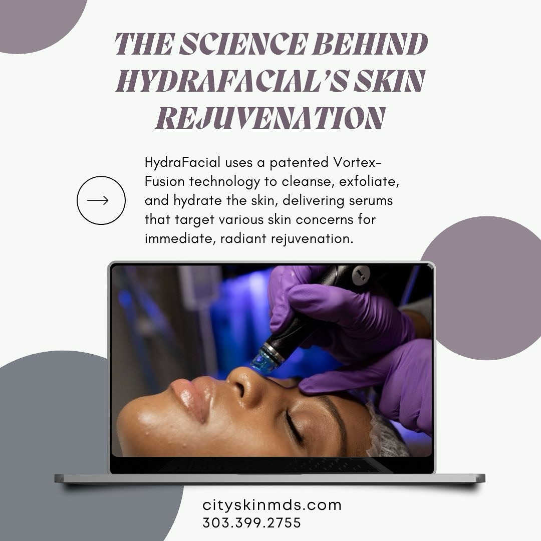 Achieve radiant, rejuvenated skin with HydraFacial’s innovative Vortex-Fusion technology! ✨ Cleanse, exfoliate, and hydrate your skin while addressing your unique concerns for that instant glow. 💧 Ready to transform your skincare routine? 🌿
📞 Call us at 303.399.2755 or visit cityskinmds.com to book your HydraFacial today!
#HydraFacial #SkinRejuvenation #GlowingSkin #SkincareGoals #FacialTreatment #HydratedSkin #VortexFusion #RadiantSkin #SelfCare #SkinCareRoutine #HealthySkin #SkinGlow #SkinCareLovers #BeautyTips #SkincareBenefits