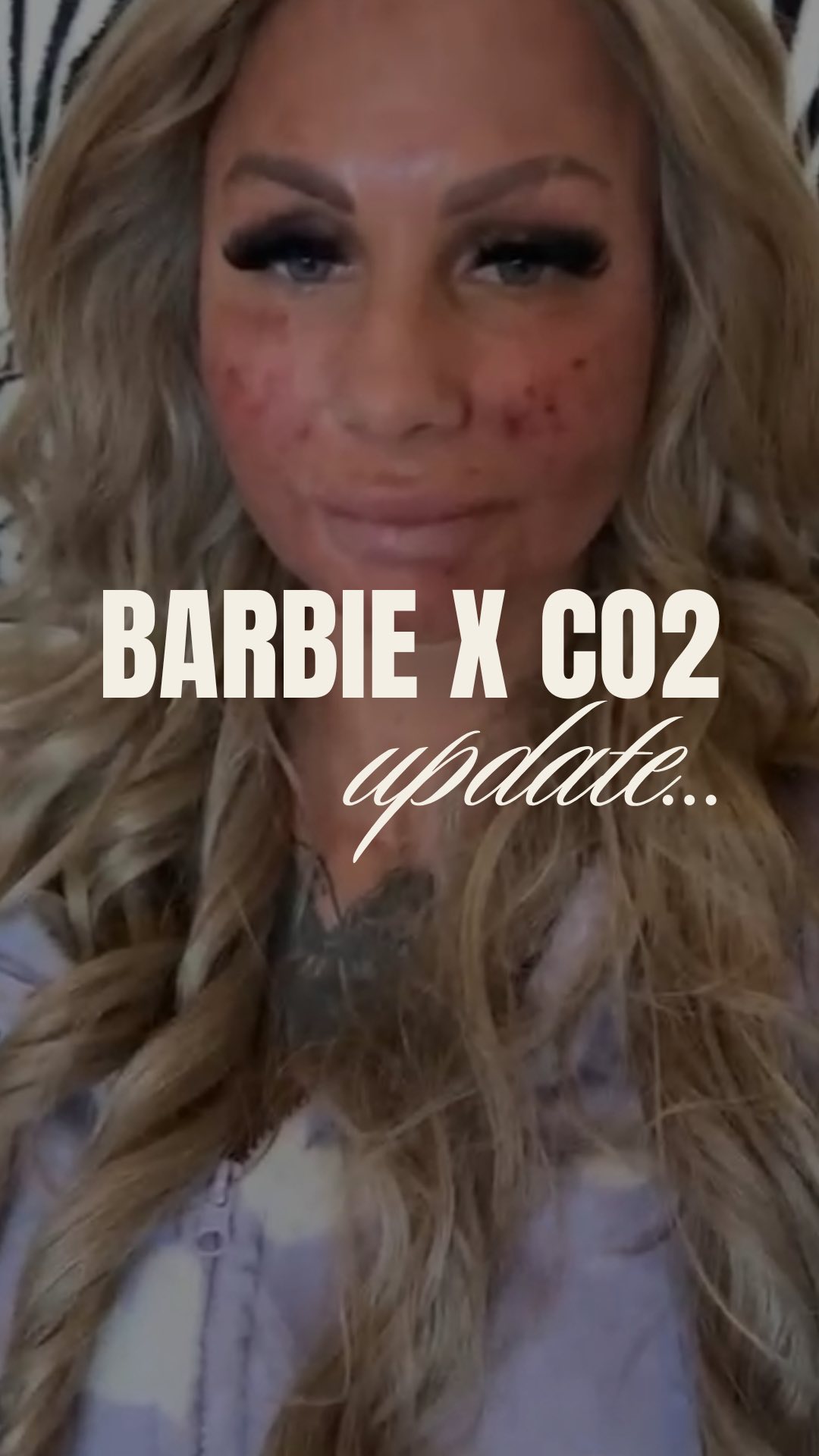 Waarom ook Barbie kiest voor CO₂ bij The Hague Clinic…
Toen Barbie bij ons binnenstapte, wist ze precies wat ze wilde: een stralende, vernieuwde huid 🤍. Niet zomaar een behandeling, maar dé CO₂-behandeling waar wij om bekendstaan. Vandaag is dag 1 van haar huidherstel, en de eerste stappen naar een gladde, gezonde huid zijn gezet.
Bij The Hague Clinic combineren we geavanceerde technologie met een persoonlijke aanpak, zodat jouw huid de aandacht krijgt die het verdient.
Heb jij last van grove poriën, littekens, rimpels of andere huidproblemen? Onze CO₂-behandeling helpt je huid herstellen!
Stuur ons een bericht met “INFO” voor meer details of om direct te boeken.
- Alles wat je nodig hebt, vind je via de 🔗 in onze bio.
Boek online een afspraak: www.thehagueclinic.nl
📞 Bel: 085 060 74 77
📧 E-mail: info@thehagueclinic.nl
LIKE, SAVE & FOLLOW als jij klaar bent voor jouw huidtransformatie.
🤍 @thehagueclinic