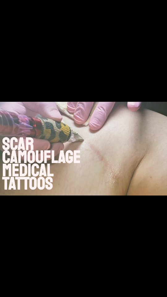 Plastic Surgeries Very Best Friend....
#scarcamouflage #scarrevision #paramedicaltattoo #medicaltattoo #scarcamouflagetattoo #scarcoverup #scarstreatment #scarlightening #lymphaticmassage #lymphdrainage #postop #plasticsurgery #plasticsurgerybeforeandafter #plasticsurgeryinstagram #plasticsurgeons #botched #plasticsurgerymexico #lipo360
#scartattoo #scarcoveruptattoo #scarremoval #microneedling #noninvasivetreatment #nonsurgical #surgicalscars #scarremover #scarred #scarreduction #scarrepair #aftersurgery