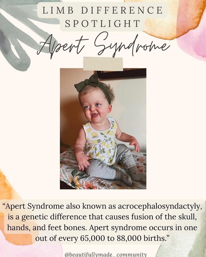 ✨Limb Difference Spotlight✨
Apert Syndrome
“Apert syndrome also known as acrocephalosyndactyly, is a genetic difference that causes fusion of the skull, hands, and feet bones. Apert syndrome occurs in one out of every 65,000 to 88,000 births.”
Children with Apert syndrome typically experience craniosynostosis and midface hypoplasia. The characteristic feature that distinguishes Apert syndrome from other types of syndromic craniosynostosis is the presence of syndactyly— a condition in which their fingers are webbed or conjoined. There are three main types of syndactyly in Apert syndrome: Type I (“spade hand”): the index, middle, and ring fingers are fused, and the thumb is free. These patients typically have a “flat” palm.
Type II (“mitten hand”): the three middle fingers and the thumb are fused, and the palm curves inward or is concave. Type III (“rosebud hand”): All fingers and the thumb are fused.
Complex syndactyly benefits from specialty surgical care to release and result in the greatest degree of function that can be achieved.”
✨RESOURCES✨
▫️Facebook-
🔎Apert Moms of the USA
🔎 Apert Syndrome
🔎Apert Syndrome and Syndromic Craniosynostosis Awareness
🔎 Apert Syndrome Information and Research Group
▫️Instagram-
@Danibeachdiaries
@facescraniofacialassociation
@myfaceorg
@bostonchildrens
@Shrinershospitals
▫️Websites-
▪️ https://www.childrenshospital.org/conditions/apert-syndrome
▪️ https://www.chop.edu/conditions-diseases/apert-syndrome
▪️ https://my.clevelandclinic.org/health/diseases/22077-apert-syndrome
————————————————————————————
If you have any other resources pertaining to Apert Syndrome please feel free to leave yourself or another page in the comments.
•
•
#beautifullymadecommunity #beautiful
#kindnessmatters #beautifullymade #representationmatters #limbdifference #limbdifferenceawareness #luckyfin #awareness #education #representation #positivity #inclusion #connect #resources #differentisbeautiful #educate
#strong #inclusiveeducation #apertsyndrome