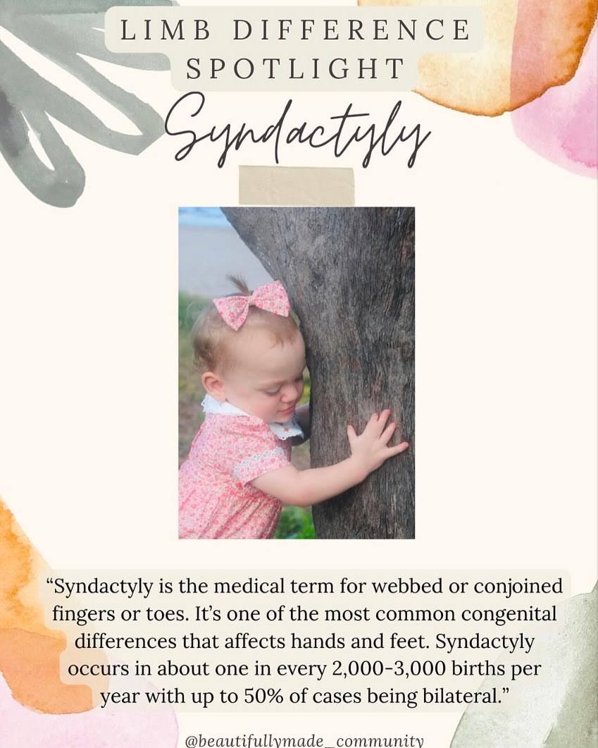 ✨Limb Difference Spotlight✨
Syndactyly
“Syndactyly is the medical term for webbed or conjoined fingers or toes. It’s one of the most common congenital differences that affects hands and feet. Syndactyly occurs in about one in every 2,000-3,000 children born each year with up to 50% of cases being bilateral.
Syndactyly is described as simple or complex. Simple syndactyly means that the fingers are joined by skin and soft tissue only. Complex syndactyly means that the underlying bones are also joined together. Complicated syndactyly means that there are extra bones, and the tendons and ligaments have developed abnormally. Syndactyly can be treated with surgery to separate the joined fingers for functional purposes. Typically, children have this operation between 1 and 2 years old.”
✨RESOURCES✨
▫️Facebook-
🔎 Syndactyly, Polydactyly Ectrodactyly, Oligodactyly
and Symbrachdactyly UK
🔎 Syndactyly Family Support
🔎 Syndactyly
🔎 Syndactyly/Symbrachydactyly
▫️Instagram-
@lucky_fin_project
@campnolimits
@handstoloveofficial
@the_hhp
▫️Websites-
▪️ https://www.chop.edu/conditions-diseases/syndactyly
▪️ https://www.childrenshospital.org/conditions/syndactyly#:~:text=What%20is%20syndactyly%3F,toes%2C%20but%20not%20as%20often.
▪️ https://my.clevelandclinic.org/health/diseases/23521-syndactyly-webbed-digits
▪️https://www.ncbi.nlm.nih.gov/books/NBK557704/
————————————————————————————
If you have any other resources pertaining to Syndactyly please feel free to leave yourself or another page in the comments.
•
•
#beautifullymadecommunity #beautiful
#kindnessmatters #beautifullymade #representationmatters #limbdifference #limbdifferenceawareness #luckyfin #disabilityawareness #awareness #education #representation #positivity #inclusion #connect #resources #differentisbeautiful #educate
#strong #inclusiveeducation #Syndactyly