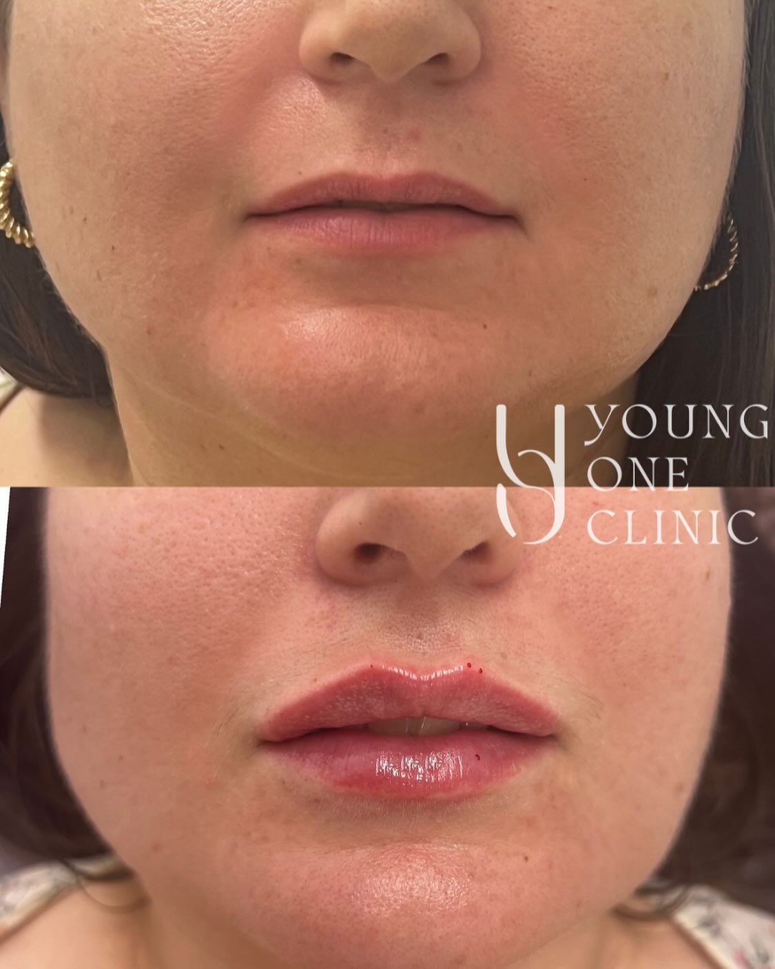 Beautifully natural result with ONE treatment ❤️
Thank you to all my patients who trust and let me post your results. I’m so grateful!
Welcome to book in a consultation to know more about:
- Lips enhancement
- under-eye rejuvenation
- Facial balancing/ contouring
- Wrinkle reduction
- Face slimming
- Bruxism/ teeth clenching
Disclaimer: All images used with consent. Individual results vary. Always seek advice from a qualified medical professional. A thorough consult is required for suitability, risks, side effects, procedure, options and aftercare. Any cosmetic or invasive procedure carries risk.
#lips #brisbane #brisbanelips #naturallips #naturalresults