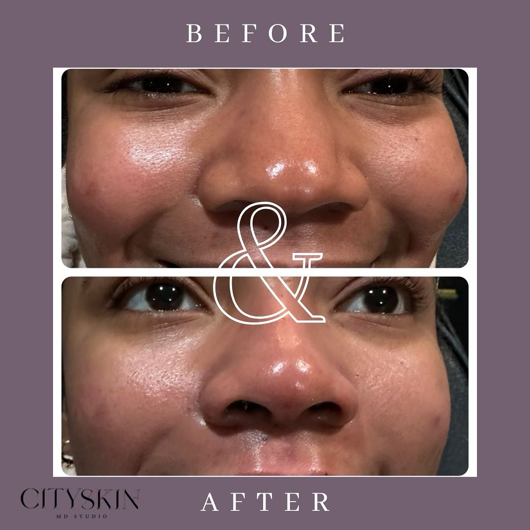 Experience a stunning transformation with our Liquid Rhinoplasty service! Check out this before and after to see the incredible results.
English & Spanish Speaking
📅 Book your appointment today and let your skin shine!
cityskinmds.com | 📞 303.399.2755
#LiquidRhinoplasty #NoseReshaping #NonSurgicalNoseJob #BeautyEnhancement #FacialAesthetics #CosmeticTreatment #BeforeAndAfter #FlawlessFeatures #NonInvasiveBeauty #BeautyTransformation #SubtleChanges #ConfidenceBoost #SculptedLook #NoseGoals #FacialContouring #CosmeticProcedures #SkinCareGoals #AestheticServices #TranquilloMedSpa #ConfidenceInBeauty #EnhanceYourLook