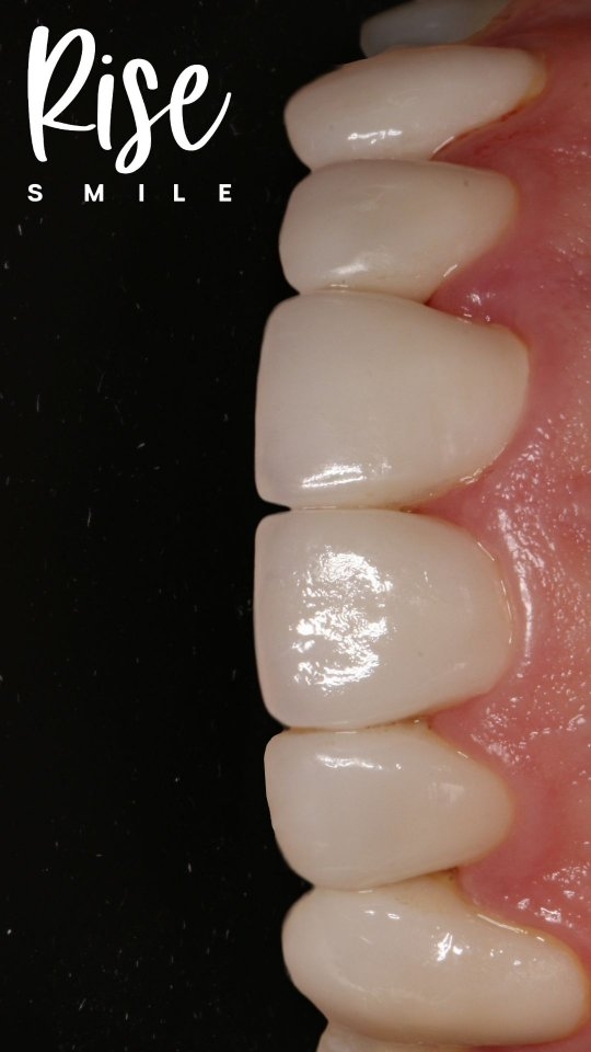 Carillas de Porcelana (Disilicato de litio)