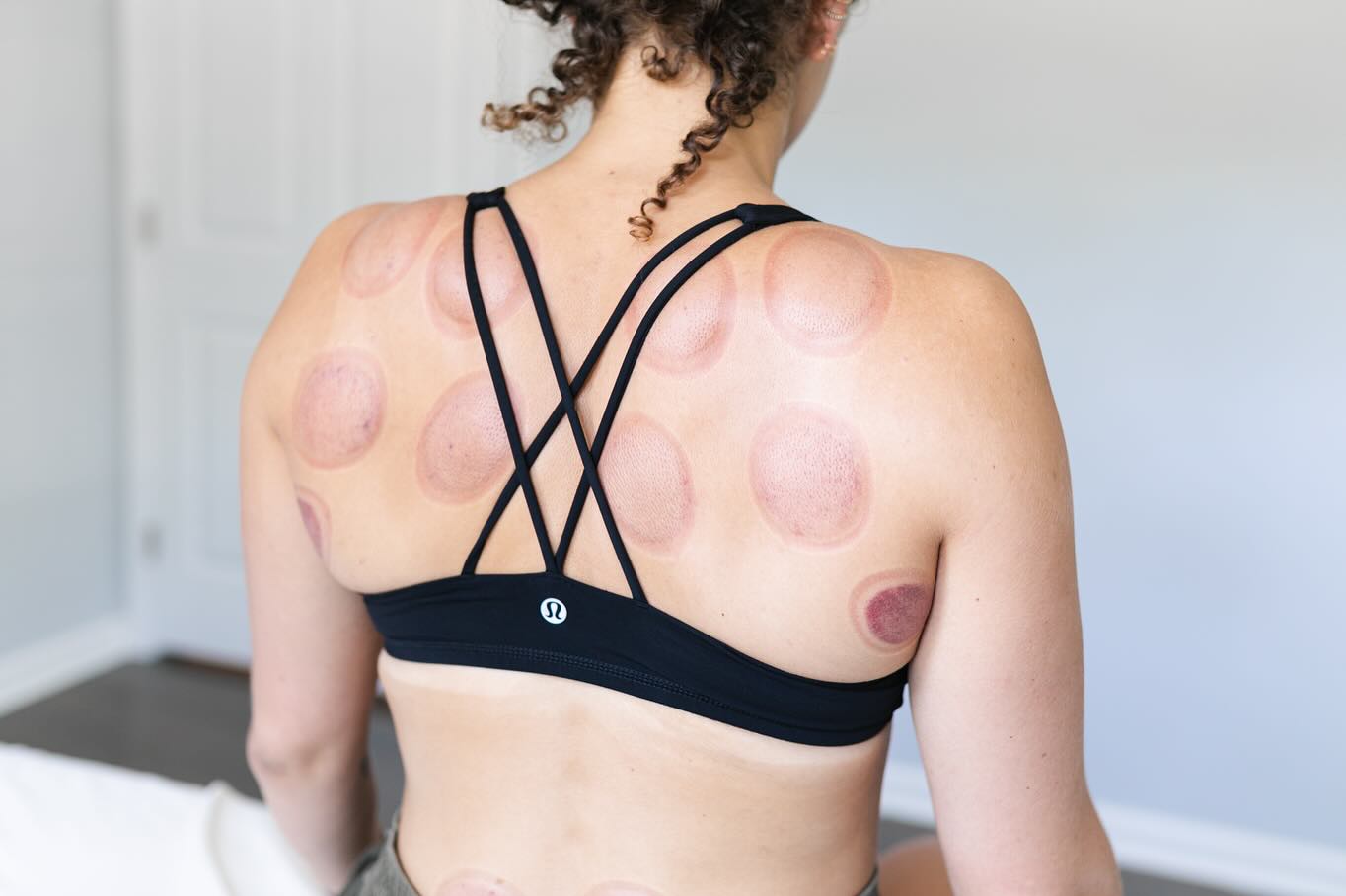 Have you ever wondered what those famous cupping marks really mean? Here’s a closer look at the benefits of this ancient healing technique and what the colors reveal about your body!
🌿 Cupping helps relieve pain, improve circulation, and support your body’s natural detox process. By creating suction, it draws congestion (or “stagnation”) to the surface where it can be processed and cleared.
🌈 The Meaning Behind the Colors:
- Light or Pale Marks: Often linked to achy or dull pain, these marks show mild stagnation or deficiency in the area.
- Darker Red or Purple Marks: This indicates deeper congestion or stagnation, often tied to sharper or more intense pain. It may also reflect a buildup of lactic acid, inflammation, or other toxins.
- No Marks: Sometimes no sha appears, which means there isn’t significant stagnation in that area—great news!
🌀 Not Bruises, But Sha
Unlike bruises caused by trauma, cupping marks (sha) are a sign of the body releasing what no longer serves it. More sha means the area had more congestion and stagnatio that needed clearing.
✨ Cupping is perfect for addressing:
- Muscle tension
- Chronic pain
- Detoxification
- Stress relief
📸 @visionbalm
#CuppingTherapy #AcupunctureCare #BreatheEasyWellness #AncientHealing #NaturalPainRelief #BreatheEasyLiveFully #acupuncture #TCM #chinesemedicine #stressrelief #painrelief