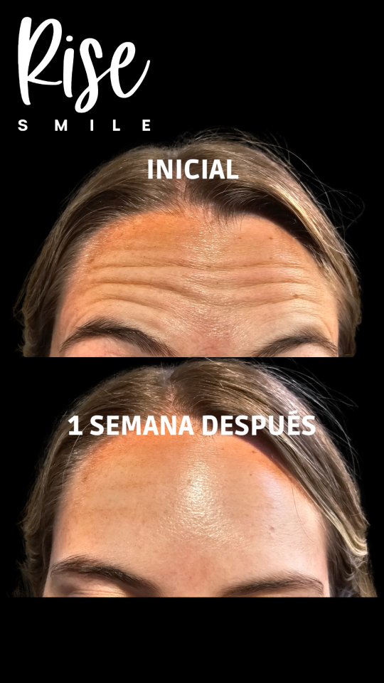 Aplicación de Toxina Botulinica, en tercio superior.
BOTOX.
Agenda una hora de evaluación!
Estamos ubicados a pasos del metro El Golf en la comuna de Las Condes.