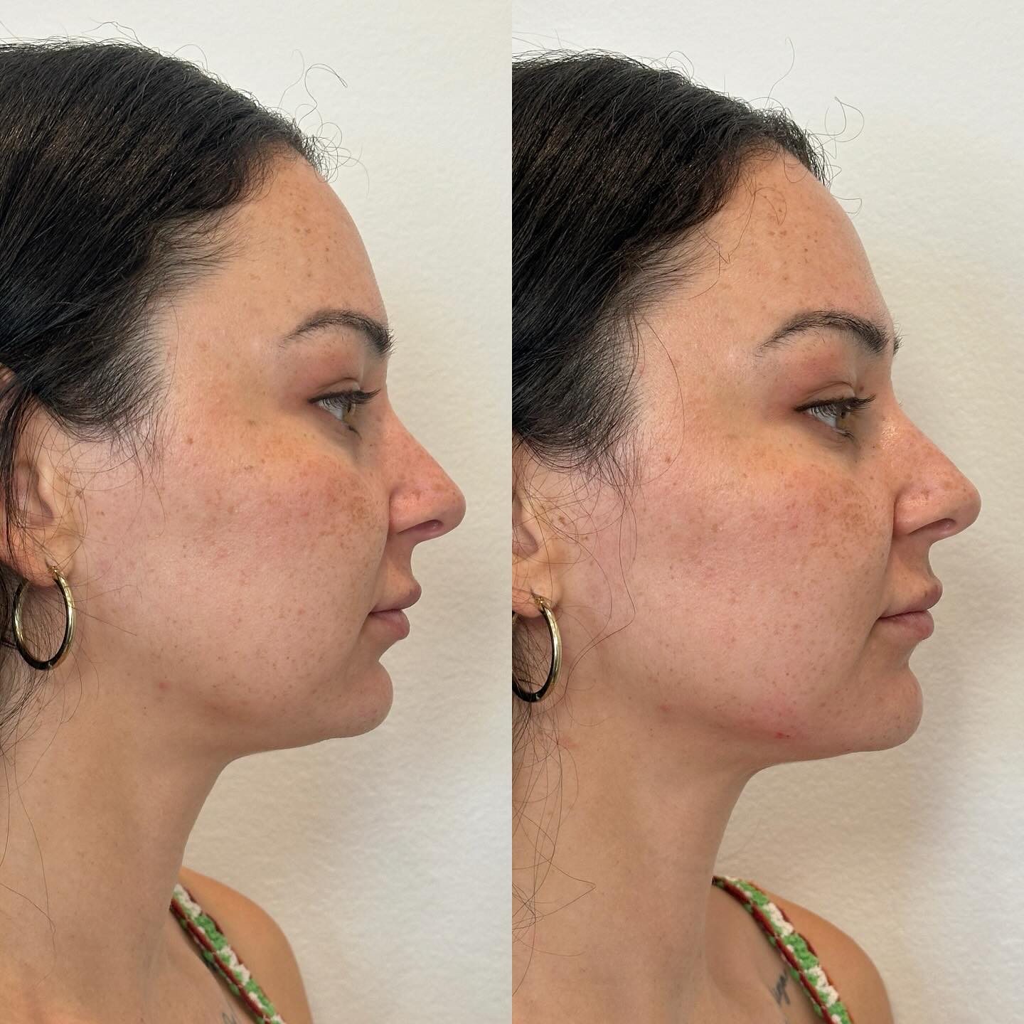 Facial balancing starting with one of the key focal points of the face, the chin!
Who would have thought that this area would gain so much popularity in aesthetics but truthfully it is key to balancing proportions of the face.
With filler you can lengthen, project, reshape and volumize this area depending on what the surrounding areas need.
It’s common to feel a little soreness post treatment but is otherwise pretty quick and easy!
Lower face filler is one of my favorite areas to work on because it can do so much for the overall image!