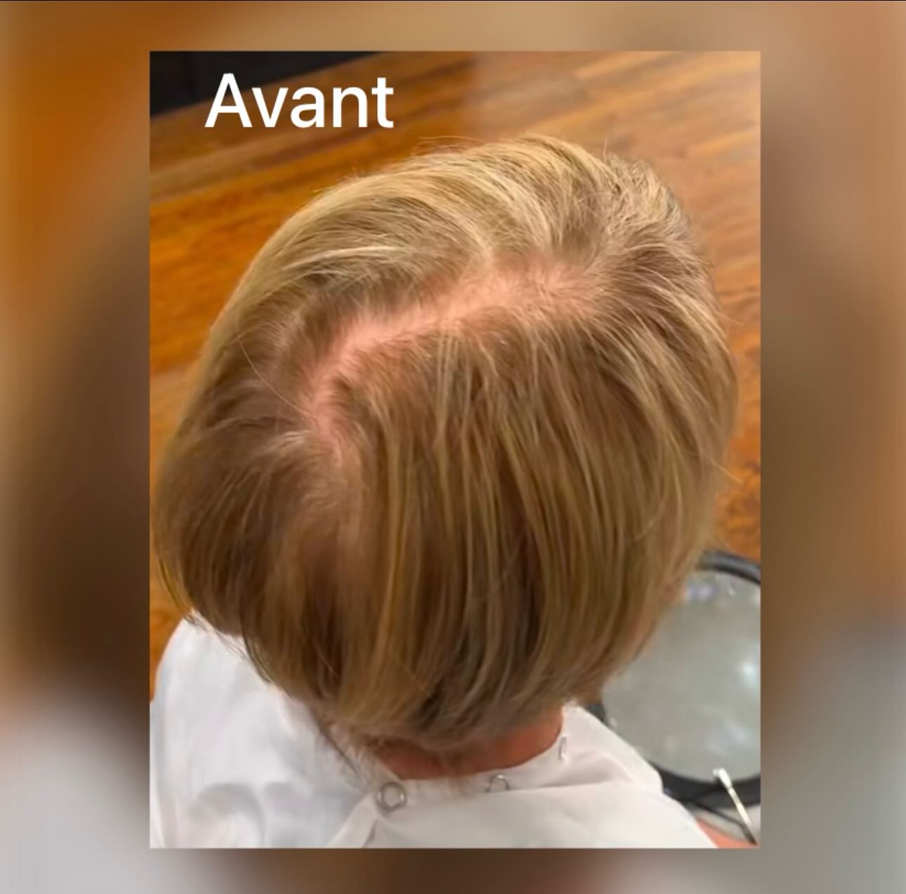 Que faire ….. ?
#alopecieandrogenetique #alopeciefemme #liguecancersuisse #liguecancerfribourg