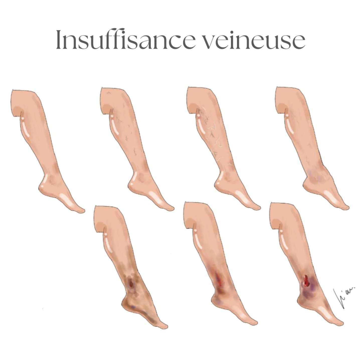L'insuffisance veineuse est une maladie chronique et évolutive. On distingue différents stades:
- C0 : pas de signes visibles, mais selon l'imagerie effectuée, montre des signes d'affaiblissement des vaisseaux veineux
-C1: télangectasies ou veines réticulaires
- C2 : varices
- C3 : œdème sans trouble cutané
- C4 : atteinte cutanée
- C5 : ulcère cicatrisé
- C6: ulcère ouvert
Dans les premiers stades, avant qu'un œdème ne s'installe il est important de soutenir et de ménager son système veineux. Surelever les jambes, doucher les membres à l'eau froide sous la douche, aller à la piscine, bouger... Ce sont des choses qui contribuent en partie, mais il est important de porter une contention adaptée le plus souvent et surtout lorsque vous êtes statique et en position debout. Ces actions éviteront que votre insuffisance veineuse évolue.
Lorsque l'œdème est déjà installé, il faut pouvoir le réduire grâce à des bandages spécifiques dans le but de faire des bas de contention adaptés. C'est inefficace de faire des bas de contention sur un œdème existant, ça le contiendra certes mais comme les tissus sont déjà en tension et en souffrance à cause du liquide présent, cela n'empêchera pas l'arrivée d'altérations cutanées à cause de l'œdème.
Lorsqu'il y a un ulcère, c'est compliqué pour une plaie de cicatriser correctement. L'œdème qui est dans la jambe exerce une certaine pression contre la plaie et l'eau s'écoule de la plaie comme d'une porte de sortie. Pour aider la cicatrisation, il est important de faire des bandages spécifiques qui d'une part réduiront l'œdème mais permettront aussi de donner une pression extérieure contre la pression de l'œdème. Cela empêchera ainsi la plaie de couler, la laissant alors cicatriser plus rapidement.
Dès qu'il y a un œdème veineux, cela veut dire que le système lymphatique est alors aussi touché. Car tant que le système lymphatique est en santé, il arrive à compenser la faiblesse du système veineux.
Ainsi il est utile selon les cas d'allier du bandage multicouche ainsi que du drainage lymphatique manuel.
Dans mon cabinet, je pratique ces deux disciplines et serai ravie de vous acceuillir si vous en avez besoin 🤗