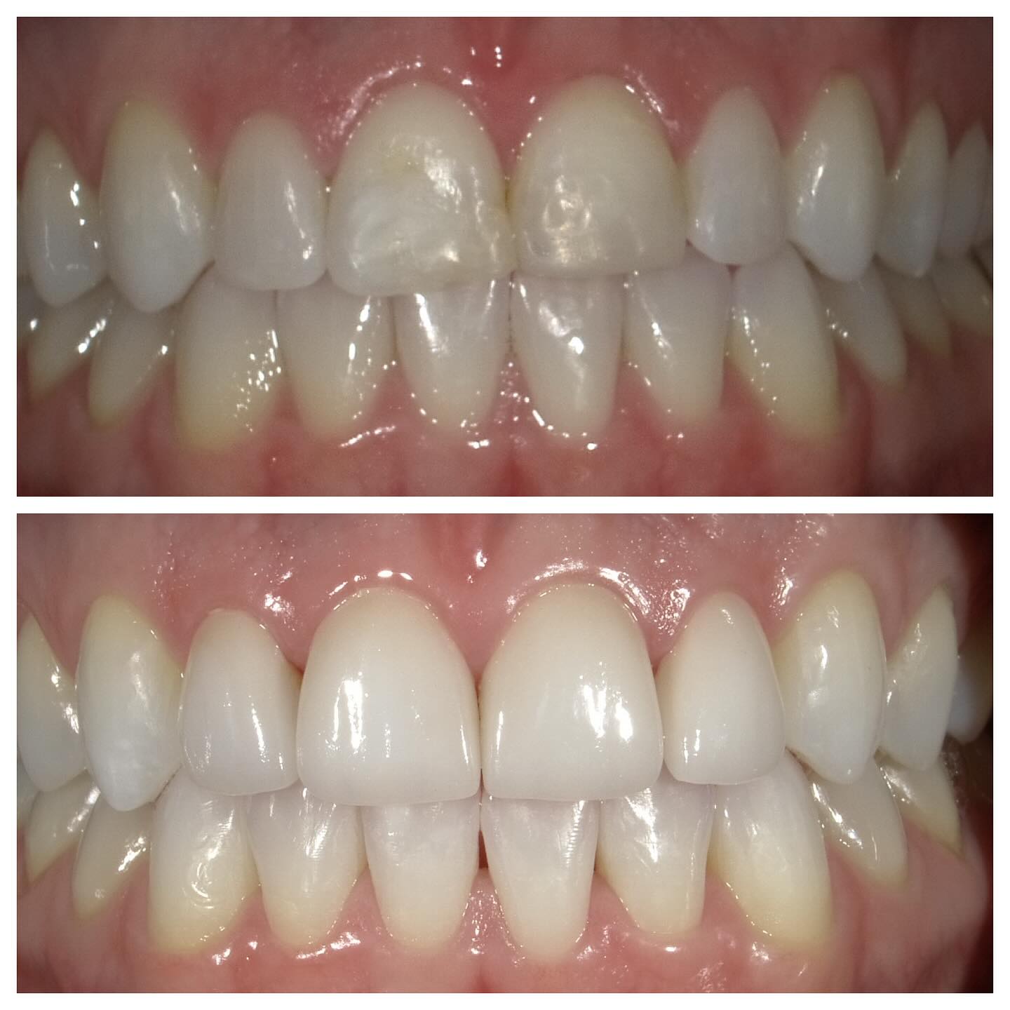 ✨ Smile Transformation Spotlight ✨
This beautiful patient in her late 20s came to us after trauma to her front teeth, which had been treated with composite fillings. Over time, she wanted a more cosmetic, lasting solution—and we delivered her dream smile in four phases:
1️⃣ Invisalign to align her teeth beautifully.
2️⃣ Teeth whitening to brighten her smile and create the perfect base for her veneers.
3️⃣ Gingivectomy to perfect her gum line for a balanced, harmonious look.
4️⃣ Veneers on her front 4 teeth to achieve a radiant, natural, yet cosmetic finish.
She was looking for something subtle yet stunning—and we think we nailed it! What do you think of her new smile? 😍
#Veneers #SmileMakeover #CosmeticDentist #Invisalign #Gingivectomy #TeethWhitening #SmileGoals #DentalTransformation #DCDentist #USCDentist