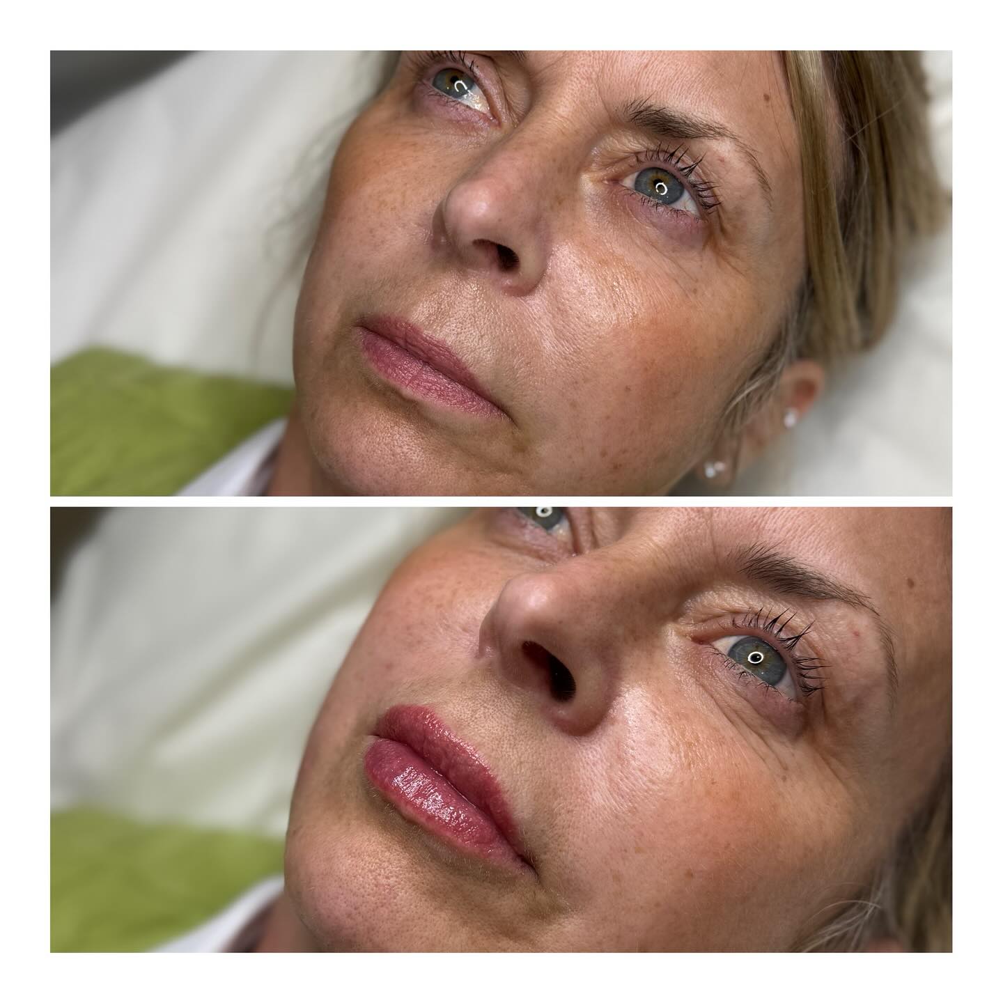 A very subtle and delicate change for this lovely lady
I did 0.5mL in the lips and treated her smile lines too.