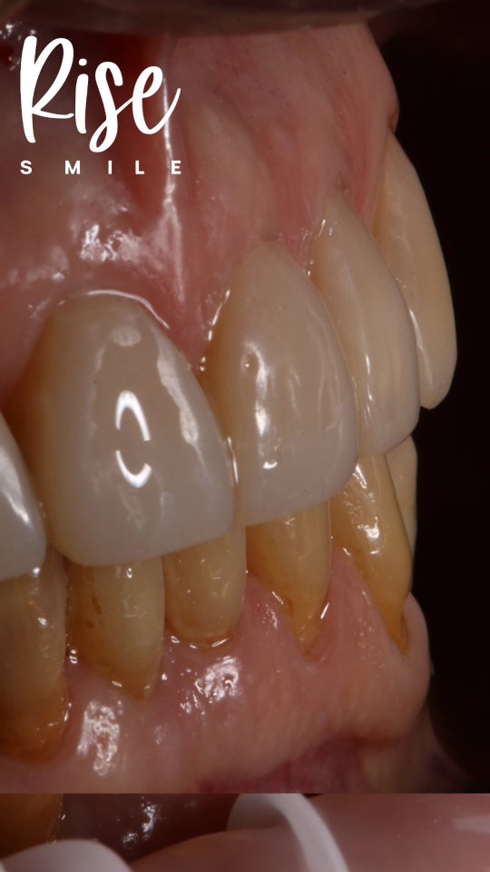 Carillas de Resina Compuesta. Resultados sin desgaste, planificación de diseño de sonrisa totalmente digital, confección en 1 sesión.