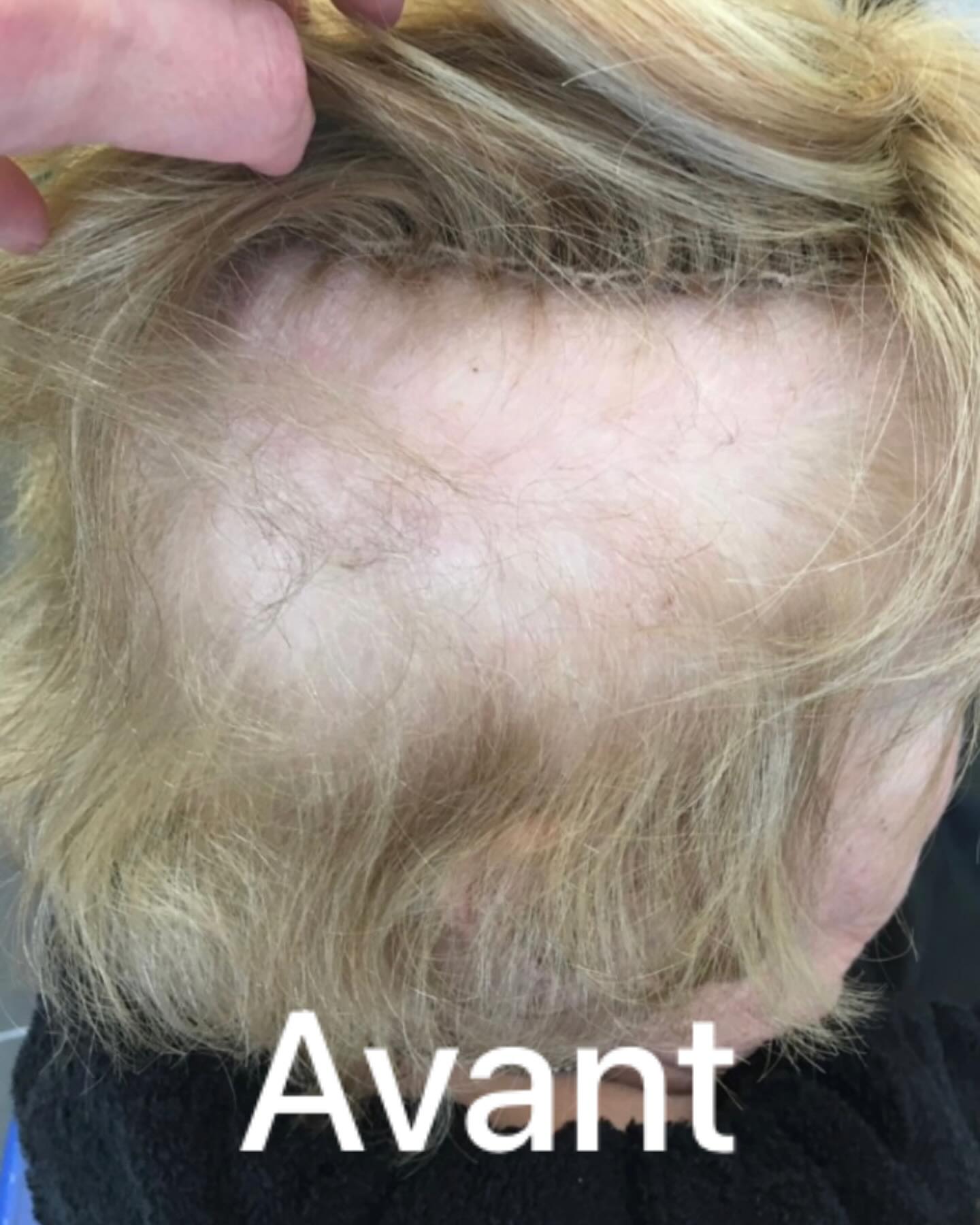 Ma cliente portait un complément qui agressait ses racines par de fortes tensions d’attaches .
Et le résultat de sa coiffure ne ressemblait à aucun style ….
#prothesecapillaire #pelade #volumateurscapillaires #liguesuissecontrelecancer #liguefribourgeoisecontrelecancer#alopecieandrogenetique