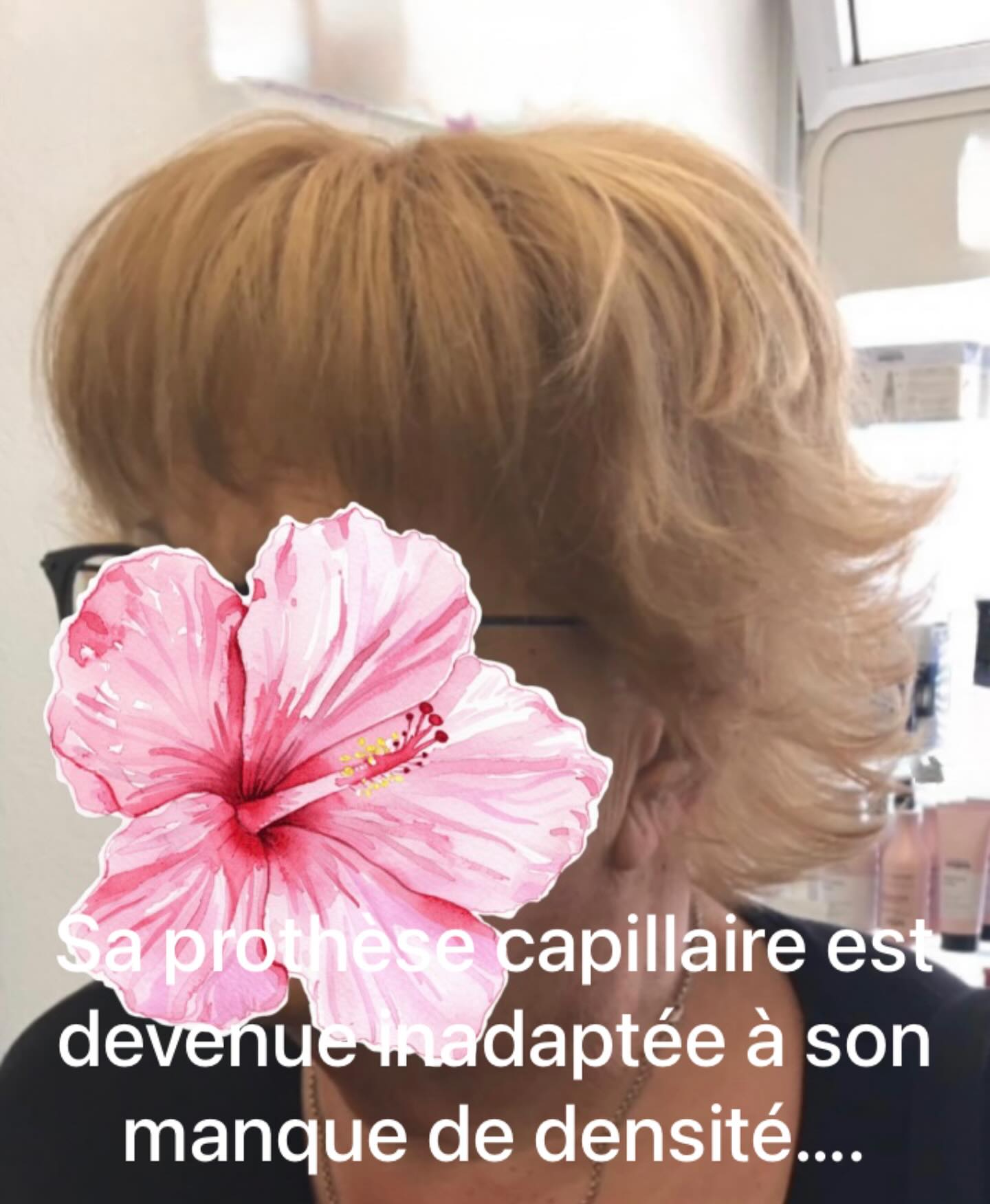 Son complément ne l’a mettait plus en valeur et devient compliqué pour se coiffer …
#alopecieandrogenetique #pelade #liguesuissecontrelecancer #liguefribourgeoisecontrelecancer