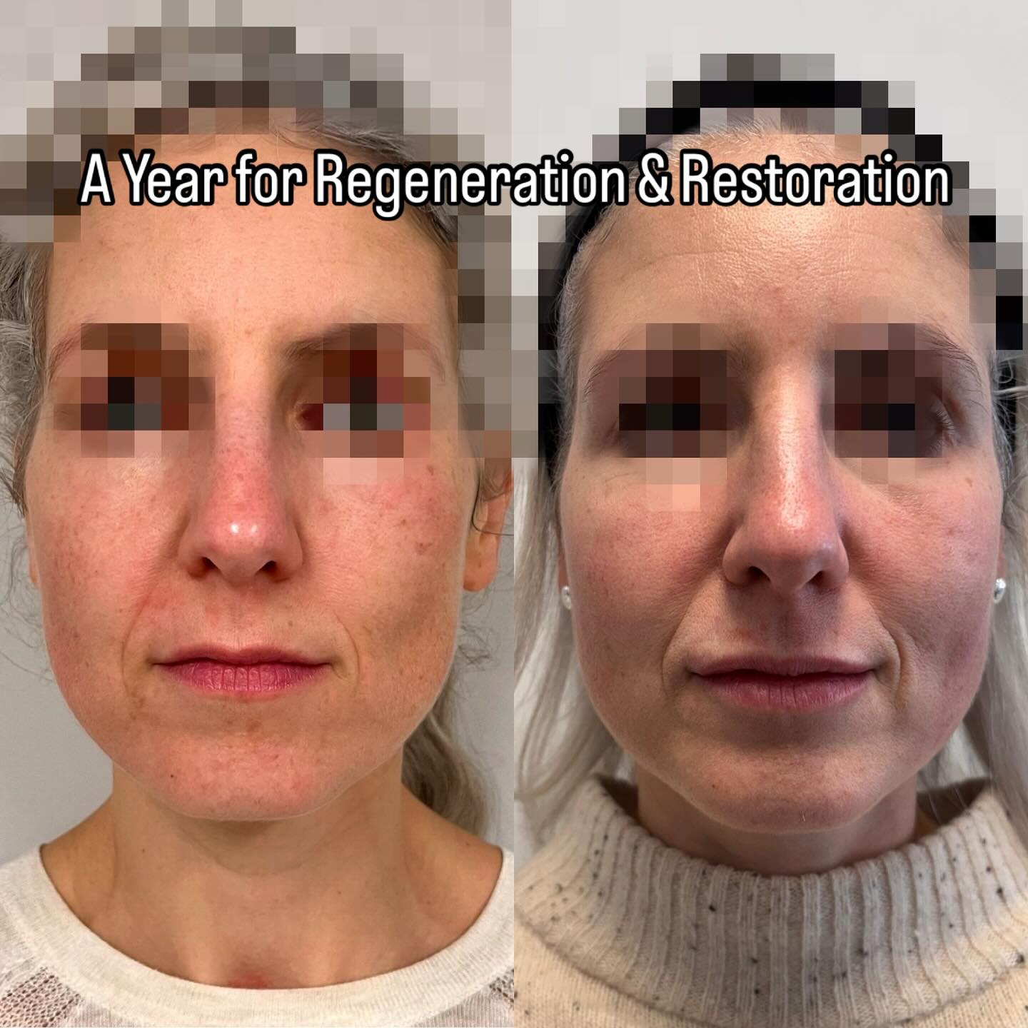 The story of a year-long voyage of renewal, revitalization, and restoration. Meticulously crafted enhancements designed to achieve specific goals. Preserve your luminosity, harmony, and equilibrium. Have you thought about rejuvenation this year? #rejuvenation #hyaluronicacid #antiaging #collagen #wrinkles #refresh #renew #plump