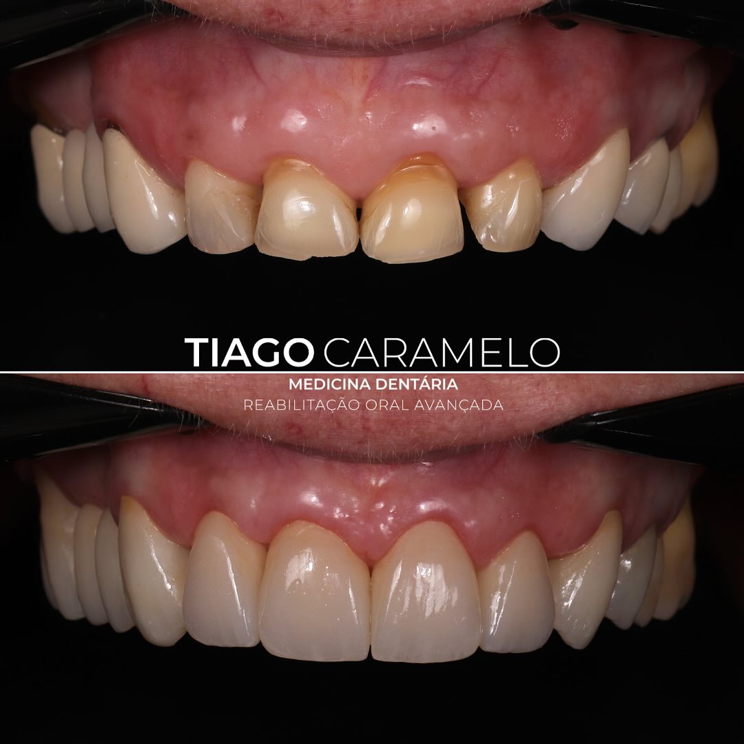 Esta paciente procurou-me para resolver vários problemas do foro estético, nomeadamente um desgaste excessivo dos dentes anteriores superiores e, ao mesmo tempo, um excesso de gengiva à volta dos mesmos. Para além disto, as pontes posteriores antigas já tinham a sua estética comprometida, pelo que necessitavam de ser alteradas. Assim sendo, o plano de tratamento começou por contemplar alongamento coronário dos 4 incisivos superiores de forma a conseguirmos aumentar a dimensão destes dentes. Posteriormente, foi realizado um aumento de DVO (dimensão vertical de oclusão) à custa do maxilar superior através da colocação de 4 coroas nos incisivos, substituição de pontes metalocerâmicas por novas pontes em zircónia e colocação de overlays table tops no restantes dentes superiores. Por fim, fiz restaurações nos caninos inferiores para repor as guias caninas e, consequentemente, garantir a funcionalidade do caso a longo prazo.
Trabalho cirúrgico realizado por @mariananunes.md
Trabalho cerâmico realizado por @margarida.msr
—————————————————————————————
This patient came to me seeking solutions for various aesthetic concerns, including excessive wear on the upper anterior teeth and, at the same time, an excess of gum tissue around them. Additionally, the old posterior bridges had already lost their aesthetic appeal and needed to be replaced. Therefore, the treatment plan began with a crown lengthening procedure on the four upper incisors to increase their dimensions. Subsequently, an increase in vertical dimension of occlusion (VDO) was achieved by restoring the upper jaw with four crowns on the incisors, replacing the old metal-ceramic bridges with new zirconia bridges, and placing tabletop overlays on the remaining upper teeth. Finally, I performed restorations on the lower canines to reestablish canine guidance and, consequently, ensure the long-term functionality of the case.
Surgical work performed by @mariananunes.md
Ceramic work performed by @margarida.msr
#oralhealth #crownlengtheningsurgery #ceramiccrowns #veneer #zirconia #overlay #tabletop #canineguidance #oralrehab #aestheticdentistry