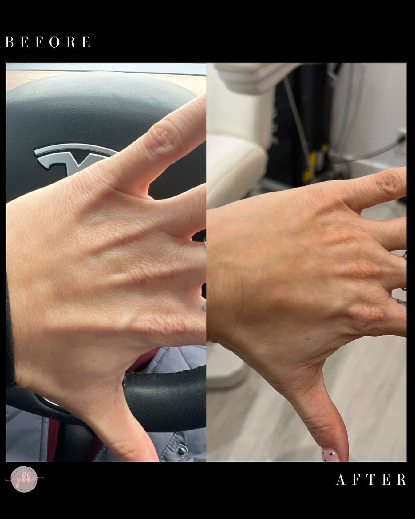 Hand fillers are an effective non-surgical treatment designed to restore lost volume, smooth out wrinkles, and minimize the appearance of veins and tendons caused by aging. By replenishing hydration and stimulating collagen production, dermal fillers help rejuvenate the hands, making them look plumper, softer, and more youthful.
.
.
To book an appointment, visit our website:
š www.prestigebeautybarinc.ca
.
.
.
.
#humberbay #neuromodulator #injections #AestheticGoals #dermalfiller