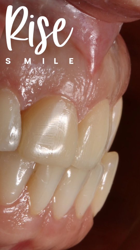 Carillas de Resina Compuesta en incisivos centrales con desgaste corrosivo por limón 🍋