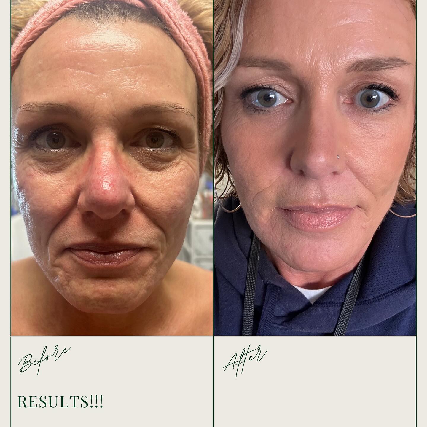 UNTOUCHED is dedicated to showing you that our skincare procedures really work! Our client received PRF filler & received immediate results. We cannot rave enough about this procedure that provides incredible results!
If you are interested in a treatment that helps soften fine lines and wrinkles & naturally tightens the skin, this procedure is for you.
📲Call us at 704-981-0045 to schedule your visit
We cannot wait to see you🤍
#prffiller #skincare #beauty #untouched #facial #prf #softenfinelinesandwrinkles