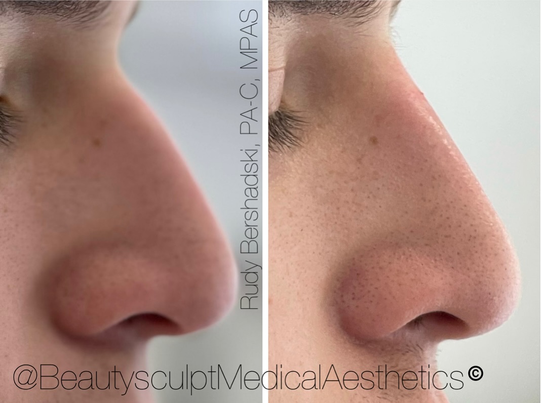 #Rhinoplasty
Platelet-rich fibrin matrix (PRFM) gel rhinoplasty.
An injection technique utilizing #PRFM gel to correct or camouflage the nasal dorsum. PRFM gel harnesses the regenerative power of platelets and growth factors. PRFM gel can create a smooth nose bridge thats difficult to achieve with traditional techniques.
Ready for the ultimate #rejuvenation experience? 📞 239-777-5002 for a complimentary consultation.
.
.
.
#rhinoplastynaples #medspanaples #medicalaestheticsnaples #injectablesnaples #medicalaestheticsnaples #rejuvinatingmedicine #antiaging