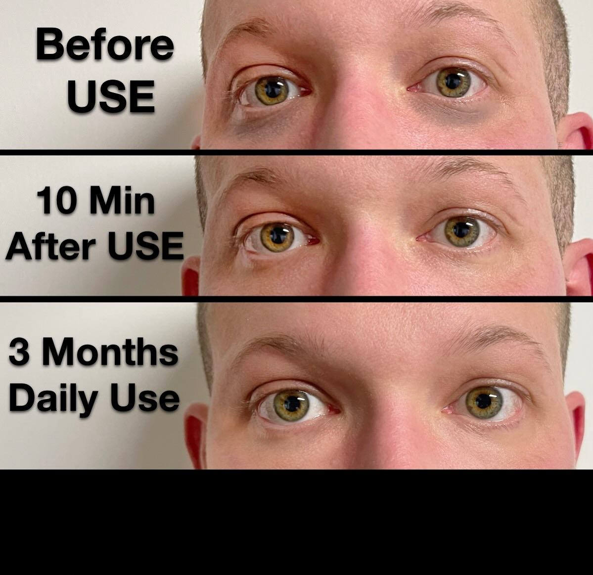 While these photos aren’t enhanced like some companies do they show REAL results with use of ReuscheMD anti-wrinkle eye cream. We like to be honest with clients and set expectations to be realistic. Our product works! Within 10 minutes of use dark circles clear and skin tightens. - Used daily for months and retinol works to correct underlying darker wrinkles whilst anti-inflammatory properties decrease presence of milia and dry keratin around eyes. #TakePrideInYourSkin #ReuscheMD