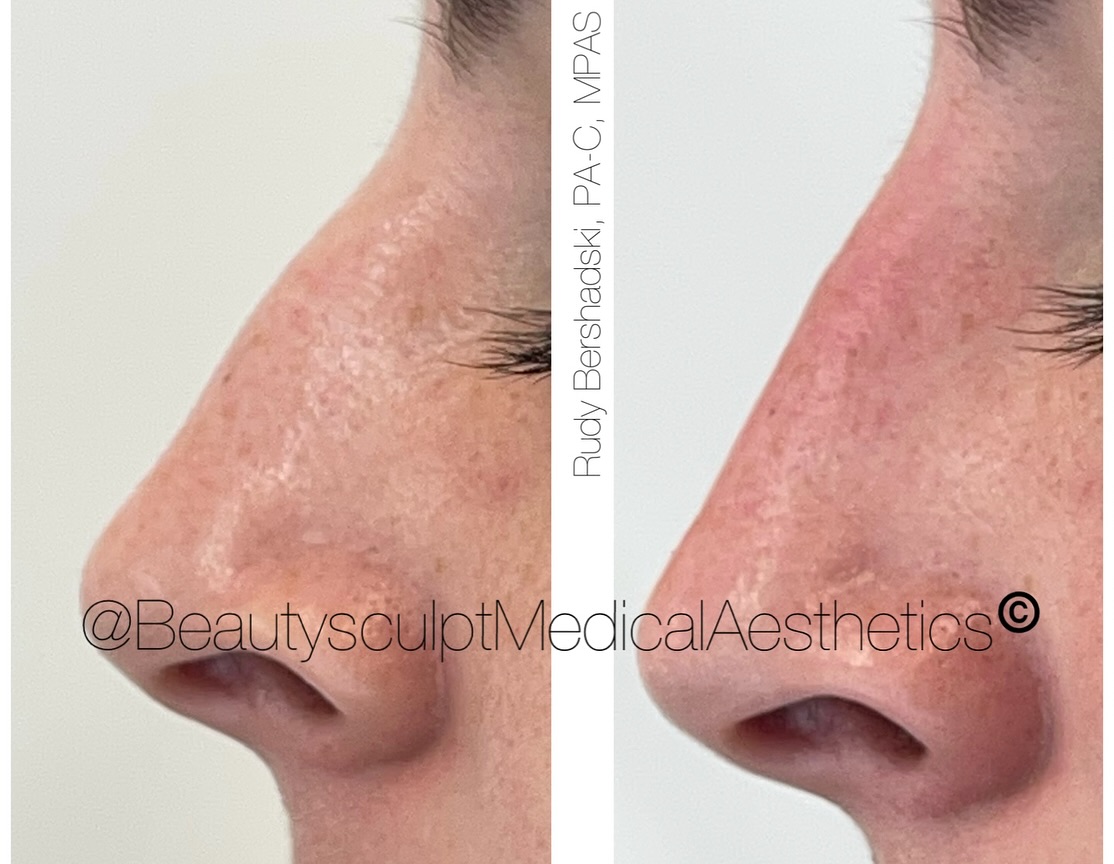 #Rhinoplasty Platelet-rich fibrin matrix (PRFM) gel rhinoplasty.
An injection technique utilizing #PRFM gel to correct or camouflage the nasal dorsum. PRFM gel harnesses the regenerative power of platelets and growth factors. PRFM gel can create a smooth nose bridge thats difficult to achieve with traditional techniques.
Call 239-777-5002 for your complimentary consultation.
.
.
.
.
.
.
.
.
#medspanaples #nosejob #medicalaestheticsnaples #injectablesnaples #rejuvinatingmedicine #antiaging