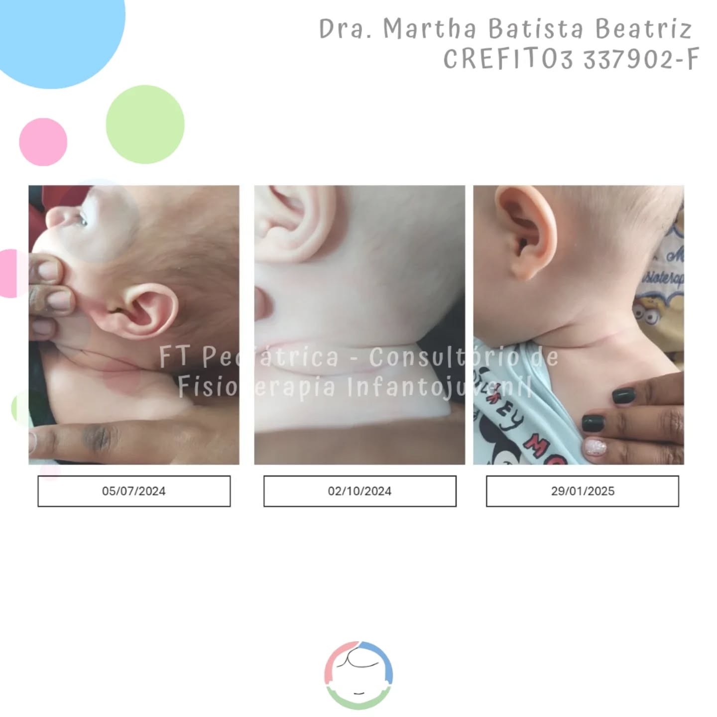 Tem bebê dando tchau para o Torcicolo Congênito 😍
E o tratamento é longo sim!!!
Sem alongar, sem provocar dor, sem lesionar o músculo que já está em espasmo!!
Respeitando o desenvolvimento do bebê e todas as etapas motoras, com base em anatomia, fisiologia e biomecânica. Tratando não só o pescoço mas todas as compensação do corpinho do bebê.
Método de Setti (em formação)
@carolinadesetti