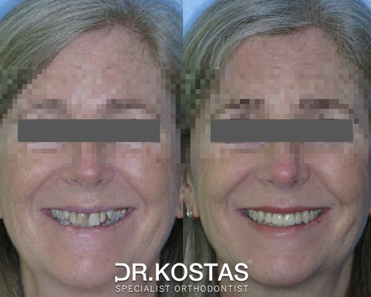 ๐ฆท It's never too late to start orthodontic treatment to achieve the confident and healthier smile you have always wanted! This patient is a great example of excellence in adult orthodontics ๐๐. Contact us today to schedule your initial orthodontic assessment and get you started. #drkostas #adultorthodontics #specialistorthodontist #braces #dublinbraces #smile #smiletransformation #dublinorthodontist #smilemakeover #dublin #orthodontics #straightteeth #teethstraightening #damonbraces #smiletransformation