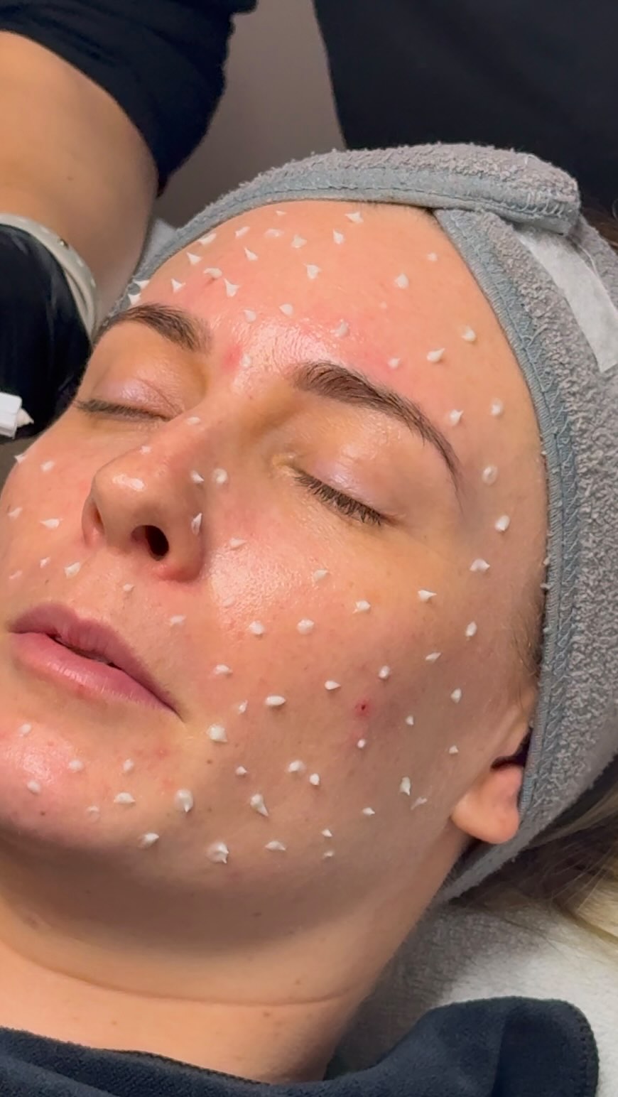 The treatment I am currently obsessed with!!!
Liquid Microneedling…..
All the benefits of traditional micro-needling with zero down time!!
50,000 Microspears placed under the skin coated in a yellow calming complex to reduce erythema and irritation!
Suitable for all skin types
Available in Birchington or Barham
#skincare #skinconfidence #microneedling #koreanskincare #beauty #selfcare