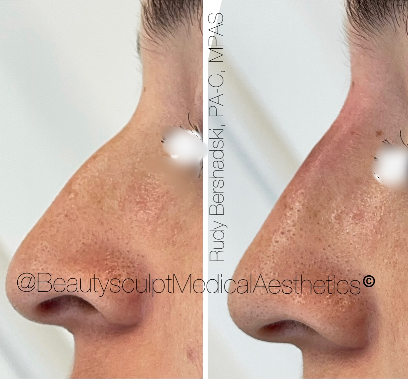 Platelet-rich fibrin matrix (PRFM) gel #rhinoplasty
An injection technique utilizing #PRFM gel to correct or camouflage the nasal dorsum. PRFM gel harnesses the regenerative power of platelets and growth factors. PRFM gel can create a smooth nose bridge thats difficult to achieve with traditional techniques.
Call 239-777-5002 for your complimentary consultation.
.
.
.
.
.
.
.
.
#medspanaples #nosejob #medicalaestheticsnaples #injectablesnaples #rejuvinatingmedicine #antiaging #beautysculptnaples