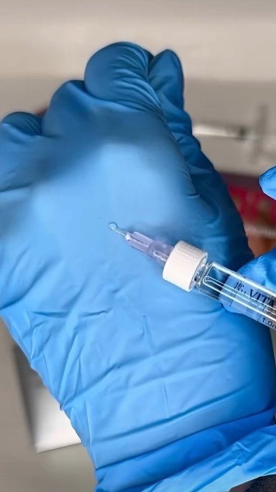 Vitaran polynukleotidit sopii tummien silmänalusten hoitoon. Lisäksi se kosteuttaa ja vahvistaa herkkää silmänympärysihoa.
Odotin useamman vuoden, että markkinoille saapuisi turvallinen ja tehokas aine silmänympärysiholle.
Hoidosta toipuu myös nopeasti!
#polynukleotidit
#vitaran