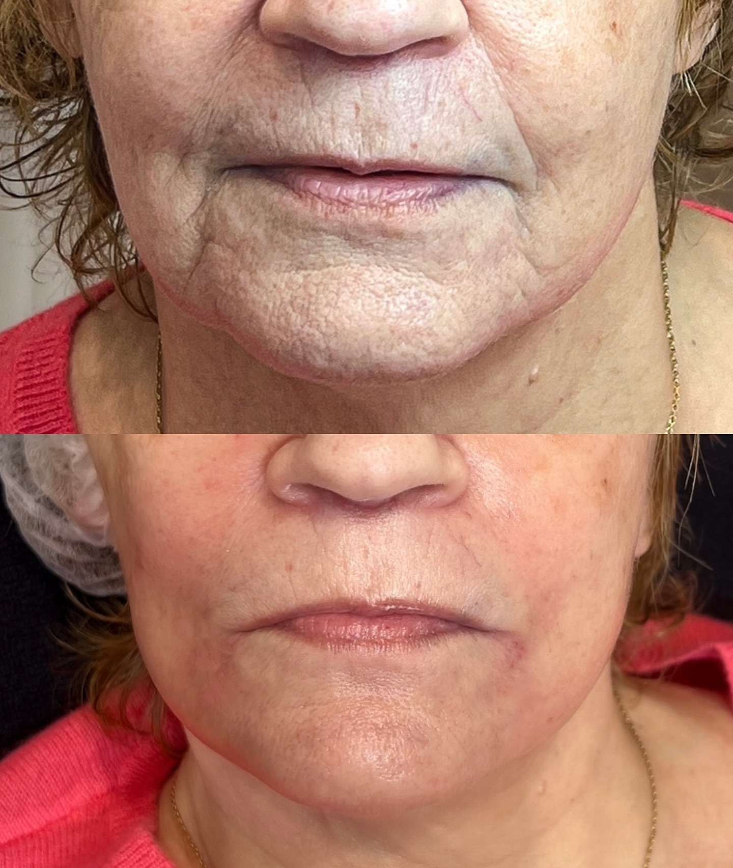 ✨ Dites adieu aux sillons nasogeniens et aux rides d’amertume ! ✨
Les sillons et les rides d’amertume donnent souvent un air triste ou fatigué… Mais heureusement, il existe une solution efficace !
📌 Traitement : injections d’acide hyaluronique