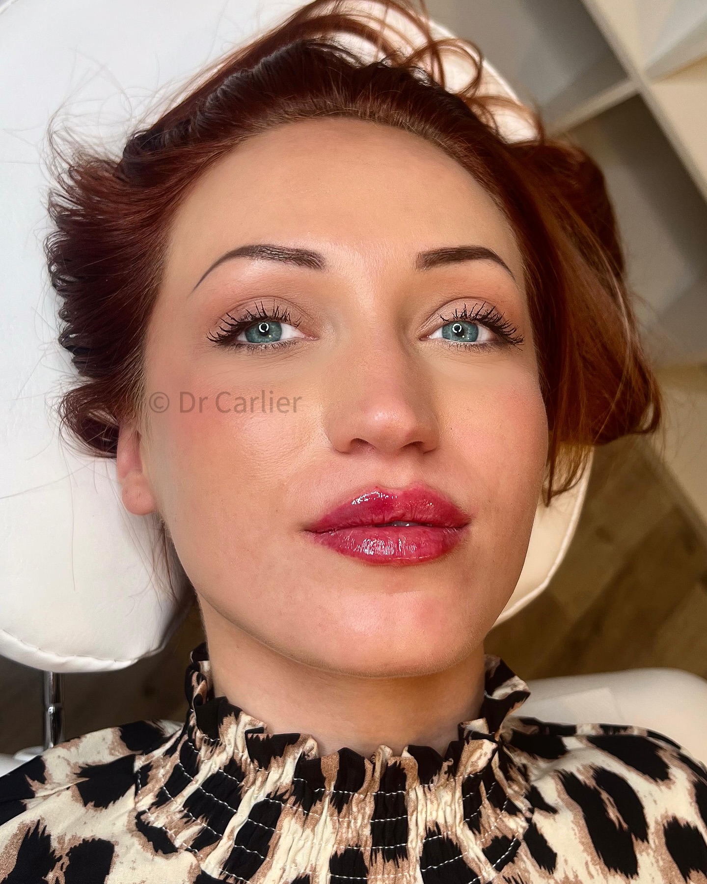 ✨Des lèvres sublimées en toute naturalité ! ✨
Ma magnifique patiente a choisi les injections d’acide hyaluronique pour hydrater, repulper et redessiner ses lèvres, tout en préservant un effet harmonieux et élégant.
💉 Résultat : une bouche naturellement mise en valeur !
Vous aussi, offrez à vos lèvres ce qu’elles méritent. Prenez rendez-vous dès maintenant !