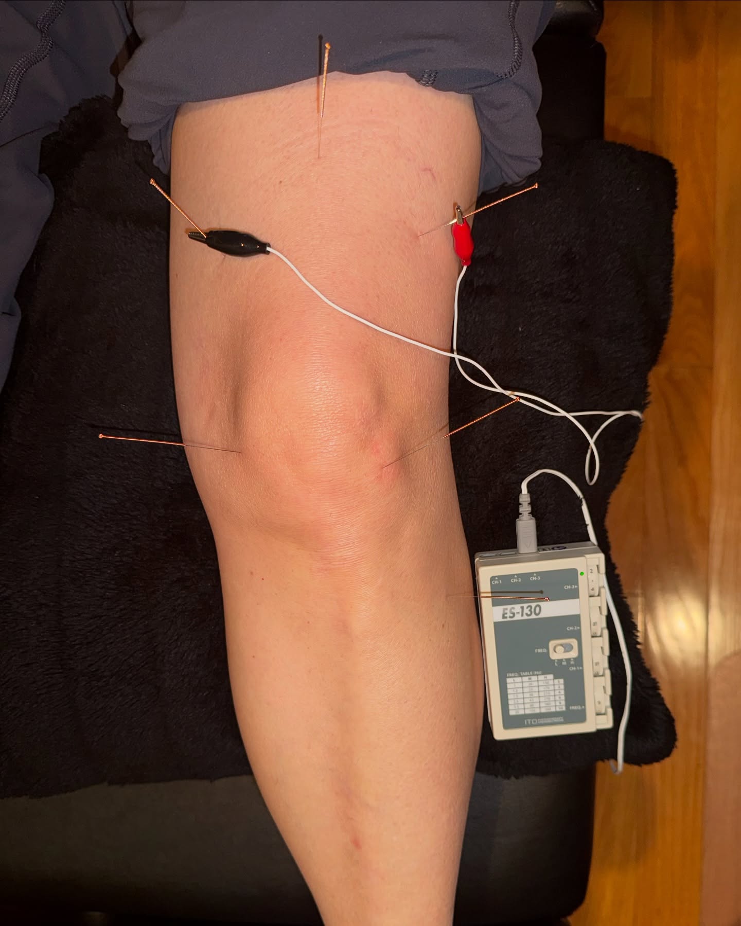 Say goodbye to knee pain! 🦵✨ Acupuncture offers incredible benefits for knee injuries and osteoarthritis, including reduced inflammation, improved blood circulation, and enhanced mobility. Say hello to pain relief and better joint function—naturally with acupuncture 📍For this patient, we are targeting all the quadriceps muscles with electrical stimulation, Stomach-36, and XiYan (eyes of the knee).
Book online using the link in my bio or send me a DM if you have any questions about how chiropractic or acupuncture could help with your knee pain 🦵🦴