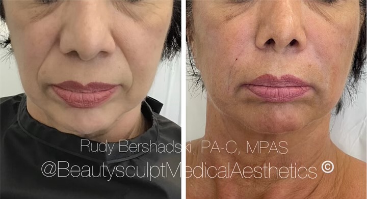 Combination treatment with #PDO Threads and HA #DermalFiller is a great nonsurgical approach to natural #rejuvenation. Achieve the laxity correction and volume repletion for contouring for that more youthful look.
Ready for the ultimate rejuvenation experience? 📞 239-777-5002 for a complimentary consultation.
.
.
.
.
.
.
.
.
#medspanaples #PDOThreadsNaples #medicalaestheticsnaples #injectablesnaples #rejuvinatingmedicine #antiaging