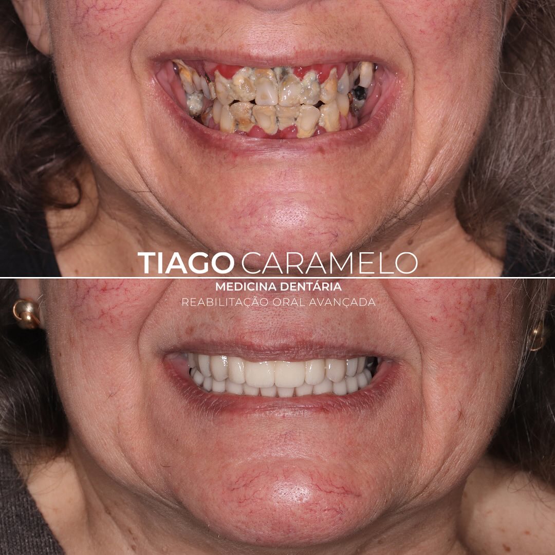 Manter dentes naturais é uma das minhas missões enquanto médico dentista da área de reabilitação. Foi isso que tentei fazer juntamente com as minhas colegas @mariananunes.md e @ho_raquelsimoes. Foram extraídos os dentes com prognóstico impossível e colocados implantes nessas posições e foram ainda realizadas facetas nos restantes dentes, de forma a dar mais estética e naturalidade a este sorriso. Por fim, a @mariananunes.md aplicou toxina botulínica para reduzir a amplitude do sorriso.
Trabalho laboratorial realizado por @daniela_cardoso7
—————————————————————————————
Maintaining natural teeth is one of my missions as a dentist in the field of rehabilitation. That’s what I tried to do alongside my colleagues @mariananunes.md and @ho_raquelsimoes. We extracted the teeth with a bad prognosis and placed implants in those positions. Additionally, veneers were applied to the remaining teeth to enhance aesthetics and provide a more natural look to this smile. In the end, @mariananunes.md applied botulinum toxin to reduce the amplitude of the smile.
Labwork performed by @daniela_cardoso7
#ao4 #allon4implants #dentalimplantsurgery #veneers #crowns #maloclinic #oralhealth #aestheticdentistry #botulinumtoxin