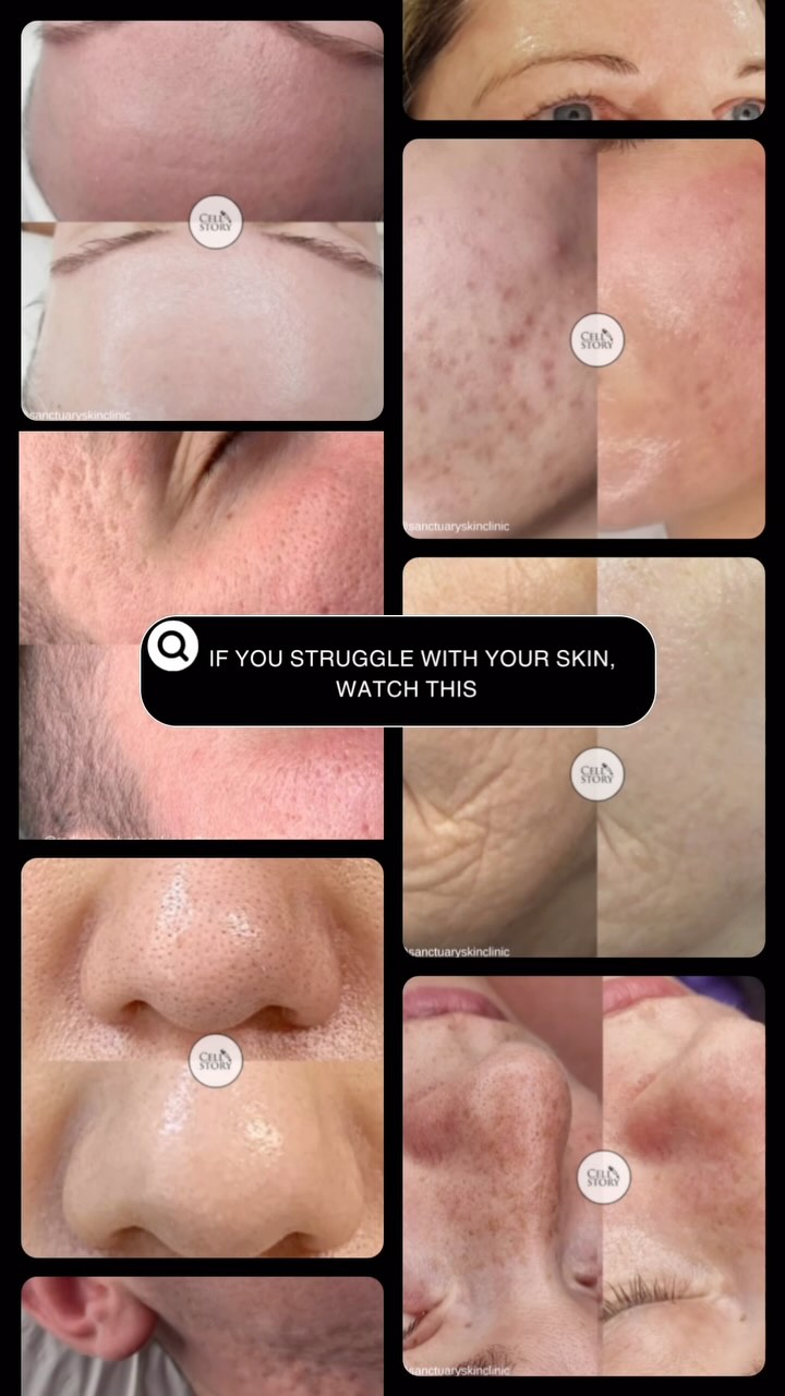 Is there anything this treatment can’t help with 🤯🤯
Suitable for even sensitive skin 🫶
A 40 minute treatment with minimal down time compared to traditional microneedling but with all the benefits!! 🥰
If you are struggling with any of the listed skin complaints please feel free to pop me a message and we can discuss your options!!
Available in Birchington and Barham
#skincare #selfcare #skinconfidence #glassskin #skingoals #beauty #healthyskin