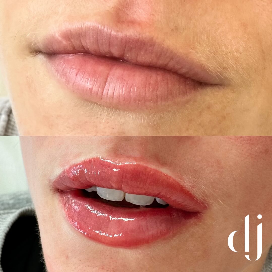 Lip Blush just got a bit juicier 💋🫦 If your not sure what type of lip blush you would like HD? Full lip colour? Sheer Lips? Borderless? Cleft Lip? Soft lipblush? Ombré lips?
We offer free consultation in clinic and we like to take the time to look at each client individually to see what would best suit them, whilst also working with your expectations of the results you would like to achieve. We love to aim to enhance the lips colour, shape and symmetry whilst keeping it natural.
At the clinic all types of Lip Blush can be done but we particularly love this look ❤️
📞 Call 0151 329 3110 to book!
✉️ DM us with your enquiries
#lipblush #lipblushing #lipliner #liptattoo #lipblushtraining #lips #lipcare #lipsliverpool #lipscare #pmulips #lipsonfleek #lipsoftheday #lipsonpoint #lipsofinstagram #biglips #lipstain #naturallipblush #semipermanentmakeup #permanentmakeup #nudeblushlips #lipblushtraining #lipblushingtattoo #lipblushartist #lipblushcourse #lipblushingtattoo #lipblushpigments