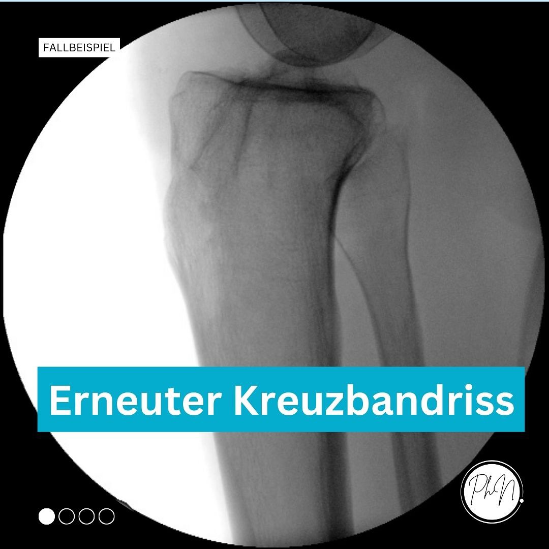 Spätestens wenn das Kreuzband ein zweites Mal reißt sollte nach Risikofaktoren gesucht werden. Die Verkippung des Schienkopfes wie bei dieser 37 jährigen Patientin stellt einen Riskofaktor dar, der mit einer Operation beseitigt werden kann. ##knie #knieverletzung #knieschmerzen #arthroskopie #kreuzband #knieexperte #gelenke #operation #orthopaedie #knieoperation #profniemeyer #reha #rehabilitation #physio #arthrose #gonarthrose #meniskus #meniskusriss