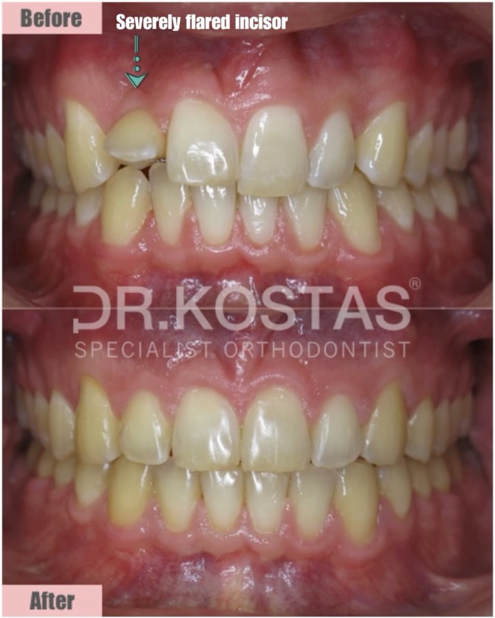 โผ๏ธ Bonded Retainers โผ๏ธ
Bonded retainers are orthodontic devices designed to keep teeth in place after braces are removed. If they are not fabricated, installed and monitored by an orthodontic specialist they can lead to significant problems over the long term and this case is a perfect example ๐ฅ โก๏ธ
This young man was about to lose one his front teeth because of an โactiveโ bonded retainer. He received orthodontic treatment elsewhere and he came to us concerned about the severely flared lateral incisor.
The orthodontic treatment with Damon-Q braces lasted 16 months and it was carefully planned & precisely executed ๐ฅ๐ฏ
We were thrilled with the end result and most importantly for managing to save โ
the patientโs front tooth โจ๐๐ป๐คฉโฃ
#drkostas #adultorthodontics
#specialistorthodontist #braces #bondedretainers #dublinorthodontist #smilemakeover #dublin #orthodontics #straightteeth #damonbraces #smiletransformation