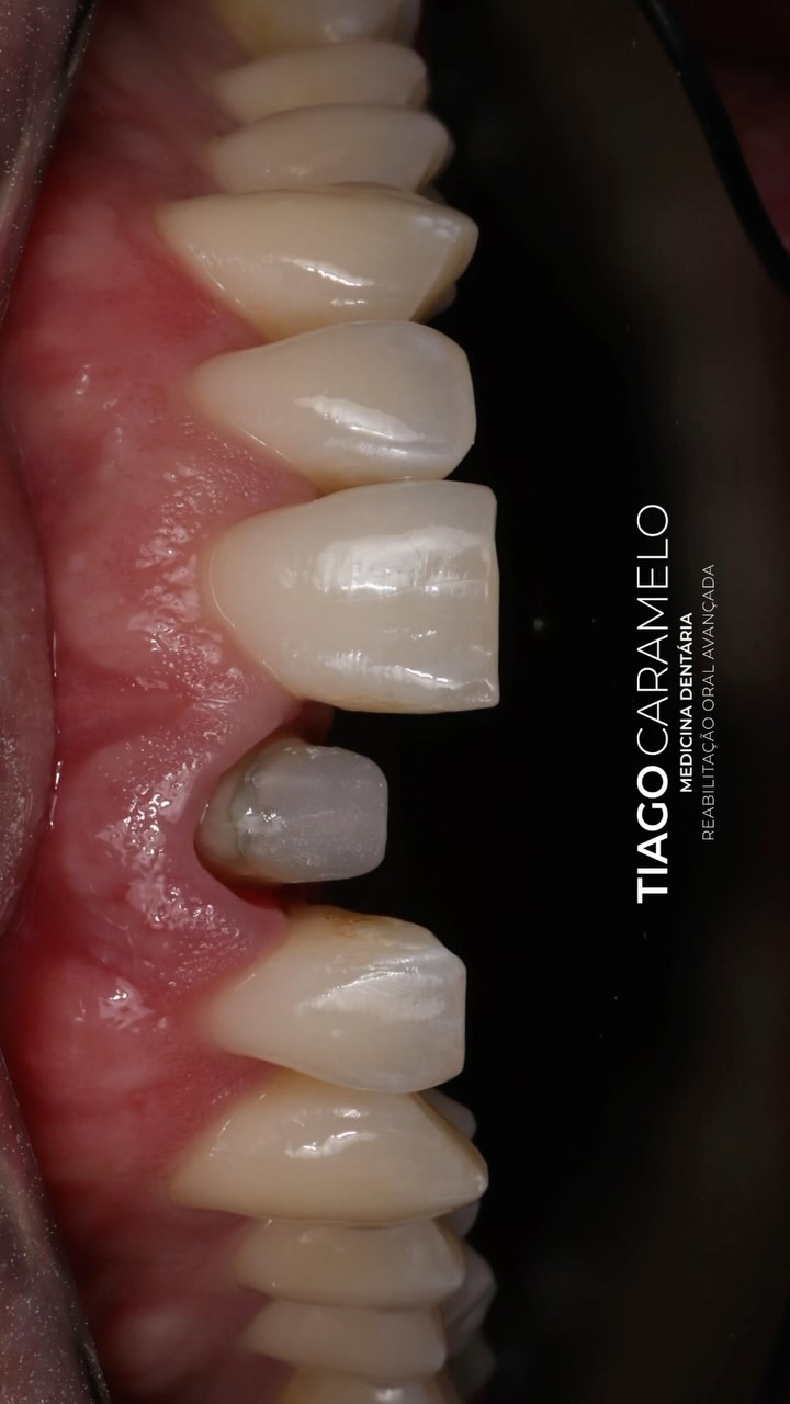 Só quem reabilita incisivos, sabe o quão difícil é reproduzir a natureza e todas as suas características. Deixo-vos alguns exemplos de incisivos reabilitados.
—————————————————————————————
Only those who rehabilitate incisors know how difficult it is to reproduce nature and all its characteristics. Here are some examples of rehabilitated incisors.
#dentalcrowns #teeth #smile #dentist