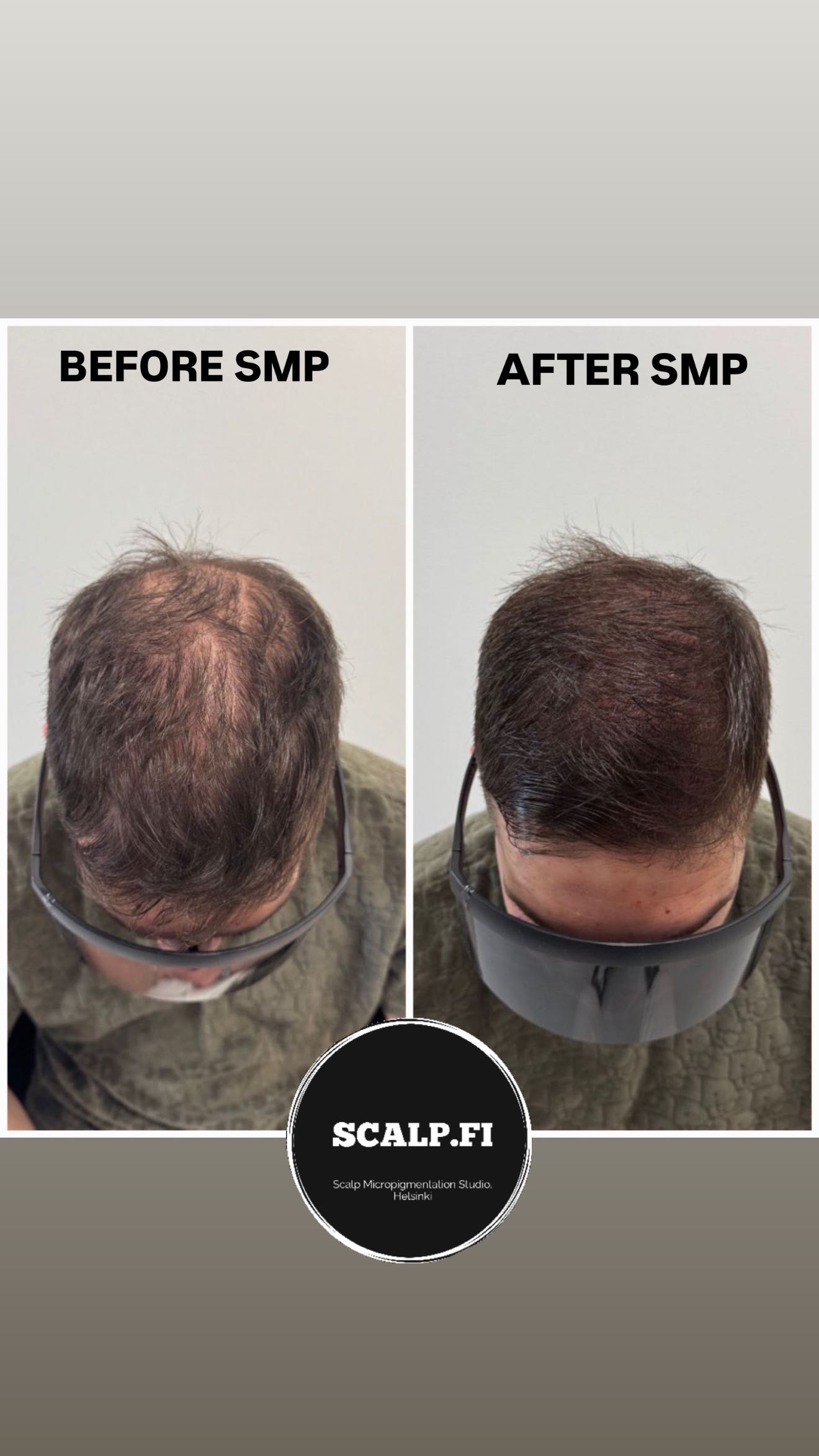 Start seeing your scalp through?
This hidden tattoo can help add density to your hair.
Get rid of bald spots with this modern innovative technique – SMP.
SMP, or Scalp Micropigmentation, imitates hair follicles and adds density – your hair will look thicker and fuller.
Feel free to contact me and ask any questions about SMP. 
✅ I am Sergei Shaikhulin, your SMP expert with 4 years of experience. 
🇫🇮 I am the owner of the Certified SMP studio in Helsinki, Finland. 🗣We speak EN, FI, RU.
🗓 Book a FREE initial consultation to get:
- answers to all your questions,
- a plan of SMP for your type of hair-loss, 
- price for your case.