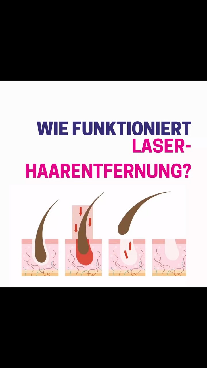 📢 Glatte Haut, ganz ohne Rasieren und Waxing – dauerhaft & stressfrei!
✨ Nie wieder Stoppeln, Rasierpickel oder eingewachsene Haare! ✨
💡 Warum lohnt sich die Laser-Haarentfernung?
✅ Dauerhaft haarfrei
✅ Sanft zur Haut – keine Irritationen
✅ Schmerarm durch High-End-Kühlung
✅ Spart Zeit & Stress
🔬 Erfahre in den Slides, wie es funktioniert & was du beachten solltest!
📍 Jetzt kostenlosen Beratungstermin sichern bei uns!
📲 DM für Fragen oder Terminbuchung!
💬 Hast du schon Erfahrungen mit Laser-Haarentfernung gemacht? Schreib’s in die Kommentare!
.
.
#tigerlilywaxing #glowup #beautyberlin #berlinbeauty #lgbtqfriendly #laserhaarentfernung #dauerhaftehaarentfernung
