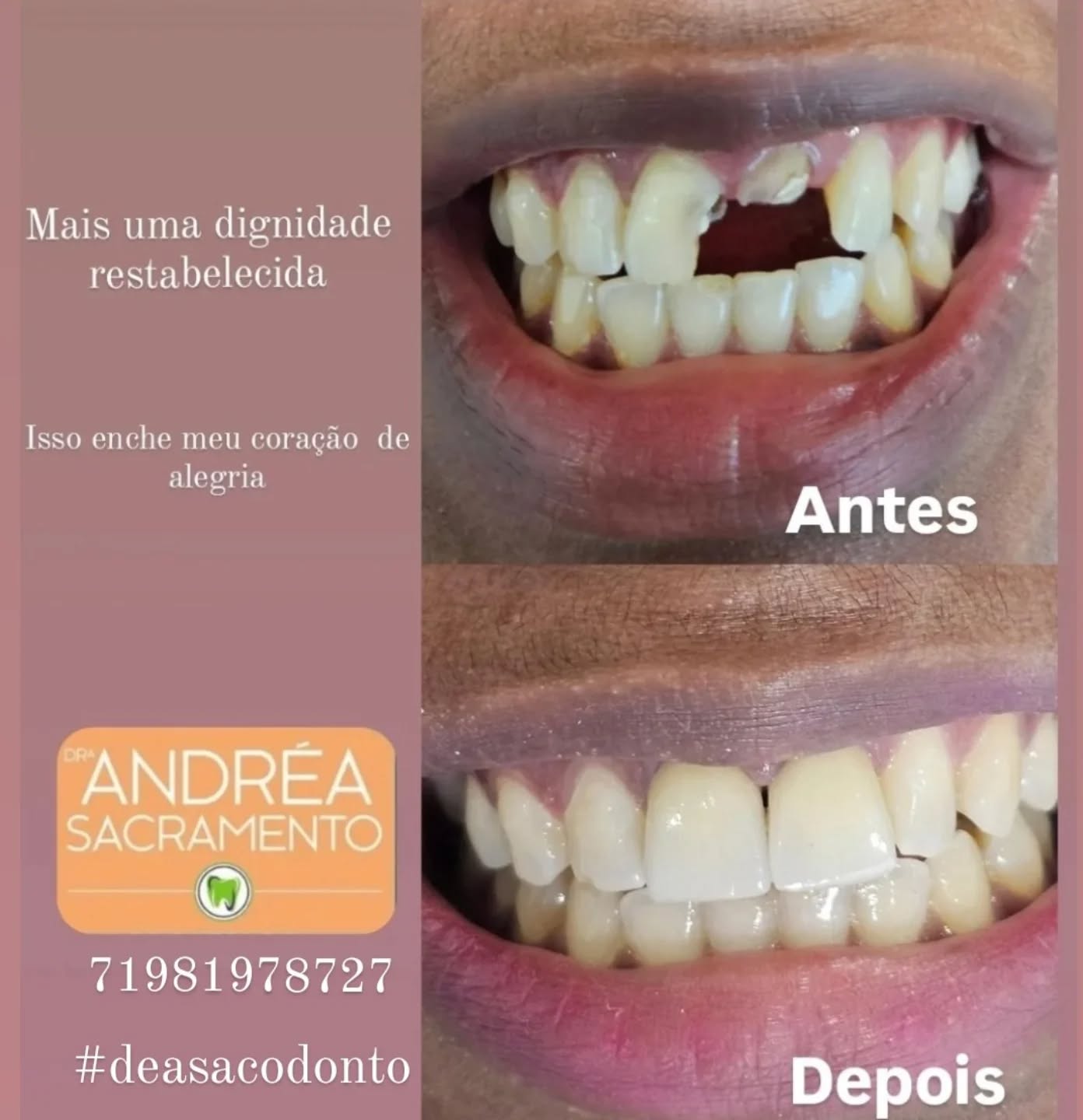 COROAS EM CERÂMICA #lentedecontato #proteseprotocolo #dentistasalvador #estetica #saudebucal #harmonizaçaofacial #clareamento #gengivoplastia #acidohialuronico #botoxsalvador #leparcsalvador #alphavillesalvador #brisassalvador #greenvillesalvador