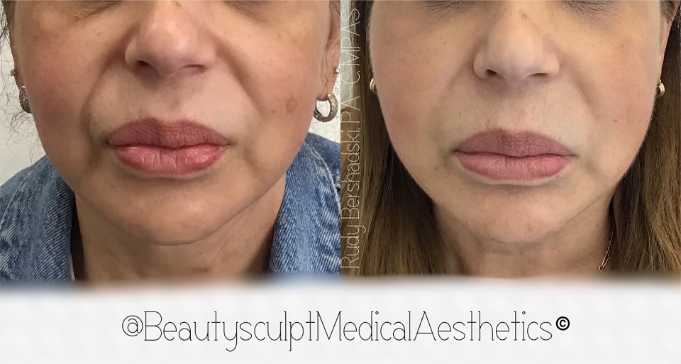 Another nonsurgical and natural appearing rejuvenation with HA #dermalfillers and #Neurotoxins. Are you ready for yours?
Call 📞 239-777-5002 for a complimentary consultation.
.
.
.
.
.
.
.
.
#medspanaples #medicalaestheticsnaples #injectablesnaples #rejuvinatingmedicine #antiaging #hylauronicacidfillers