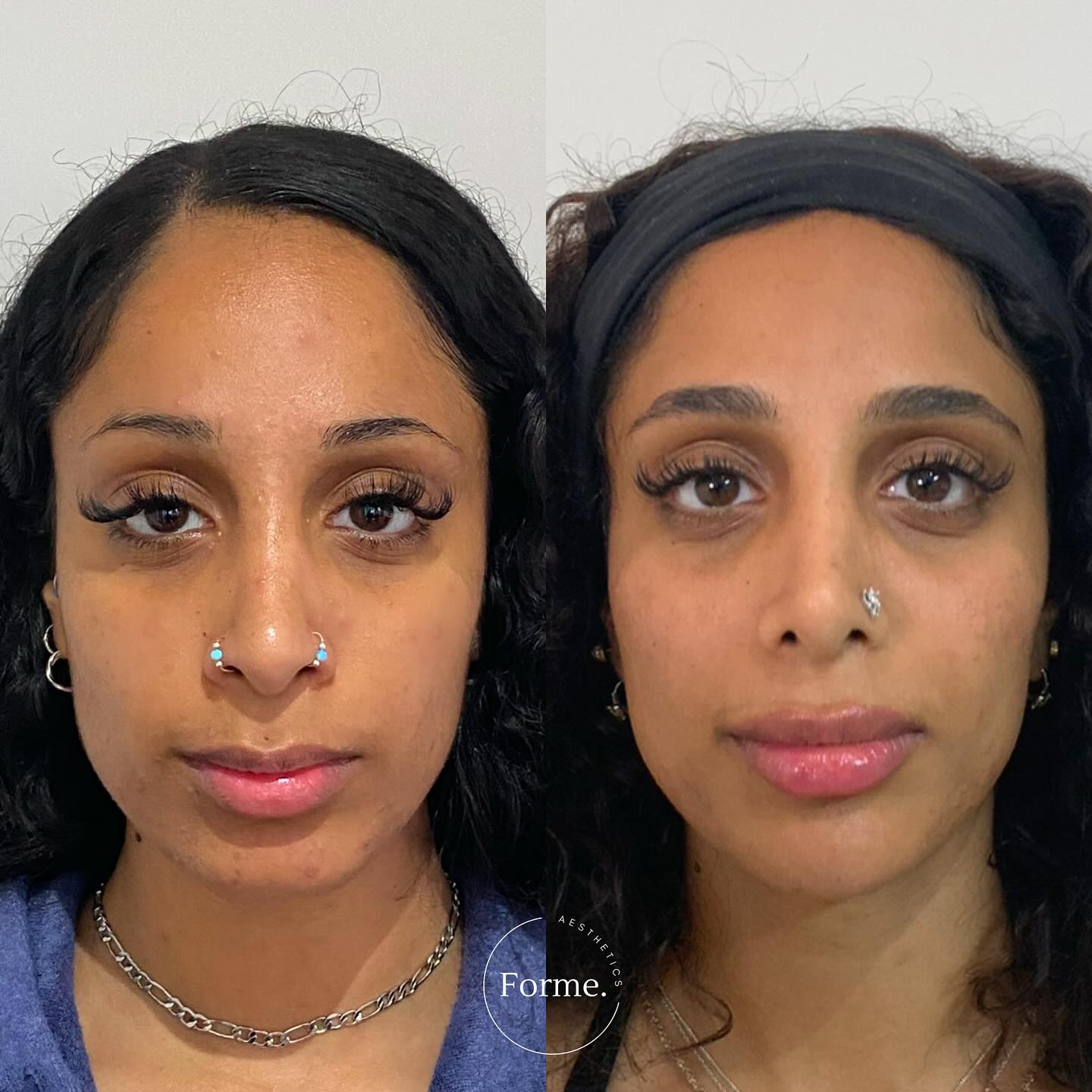 Ever looked back at an old photo and realized how much you’ve changed? We see ourselves every day, so it’s easy to miss the subtle shifts over time.
This beautiful patient has been seeing me for four years, with the goal of maintaining balance, structure, and harmony—keeping her looking like herself. Small, thoughtful tweaks over time make all the difference without ever feeling “done.”
The best results are the ones that make you feel refreshed and confident, without anyone knowing why.
Any surgical or invasive procedure carries risks. Before proceeding, you should seek
a second opinion from an appropriately qualified health practitioner. Results vary.
Consent is always obtained before sharing patient images.
Treatment performed by Stephanie Sirillas RN