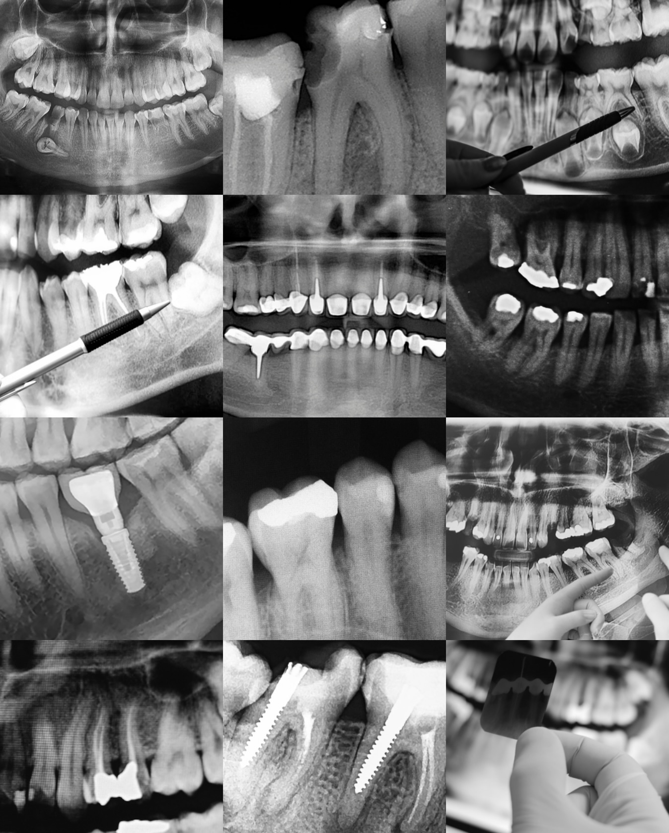 X-rays are a crucial part of
dentistry.
They help us spot issues that
aren’t visible to the naked eye,
like cavities between teeth,
infections in the bone, or
impacted wisdom teeth.
By catching problems early, we
can prevent bigger, more
painful issues down the road.
🦷✨
#dentalxray #oralhealth
#preventivedentistry
#healthyteeth #dentistcare