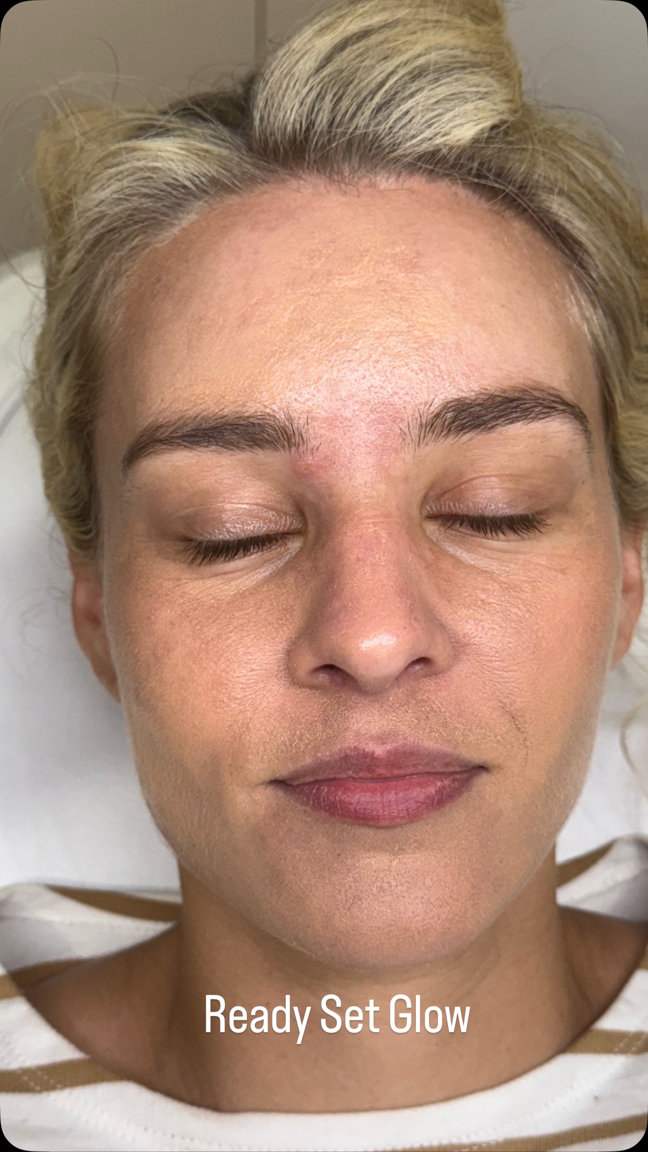 ✨ Unlock Radiant Skin with Microneedling! ✨
Microneedling is your skin’s best-kept secret for a youthful, glowing complexion! This powerful treatment stimulates collagen production, helping to:
✔️ Reduce fine lines & wrinkles
✔️ Improve skin texture & tone
✔️ Fade acne scars & pigmentation
✔️ Minimize pores for smoother skin
✔️ Boost product absorption for better results
Ready to reveal fresh, rejuvenated skin? Book your microneedling session today! ✨
#GlowFromWithin #MicroneedlingMagic #SkinRejuvenation #SmootherSkin #SkinPerfection #WeddingReadySkin #YouthfullGlow #IllawarraSkin #WollongongSkin #LaBelleSkinTherapy